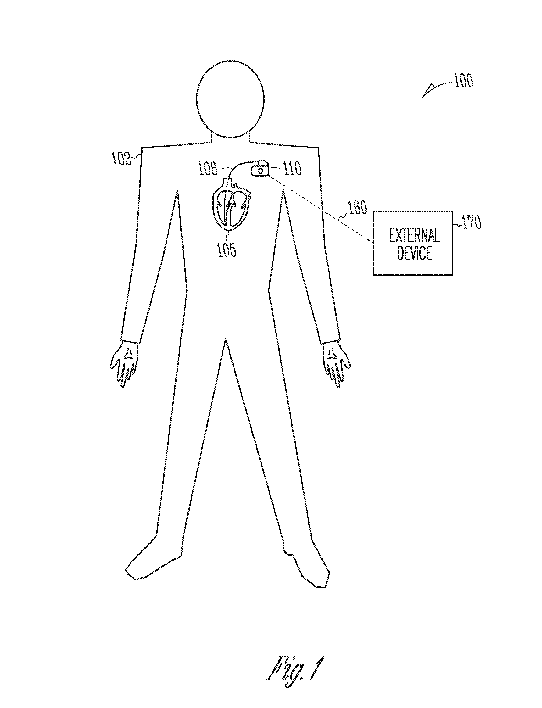 Heart attack or ischemia detector