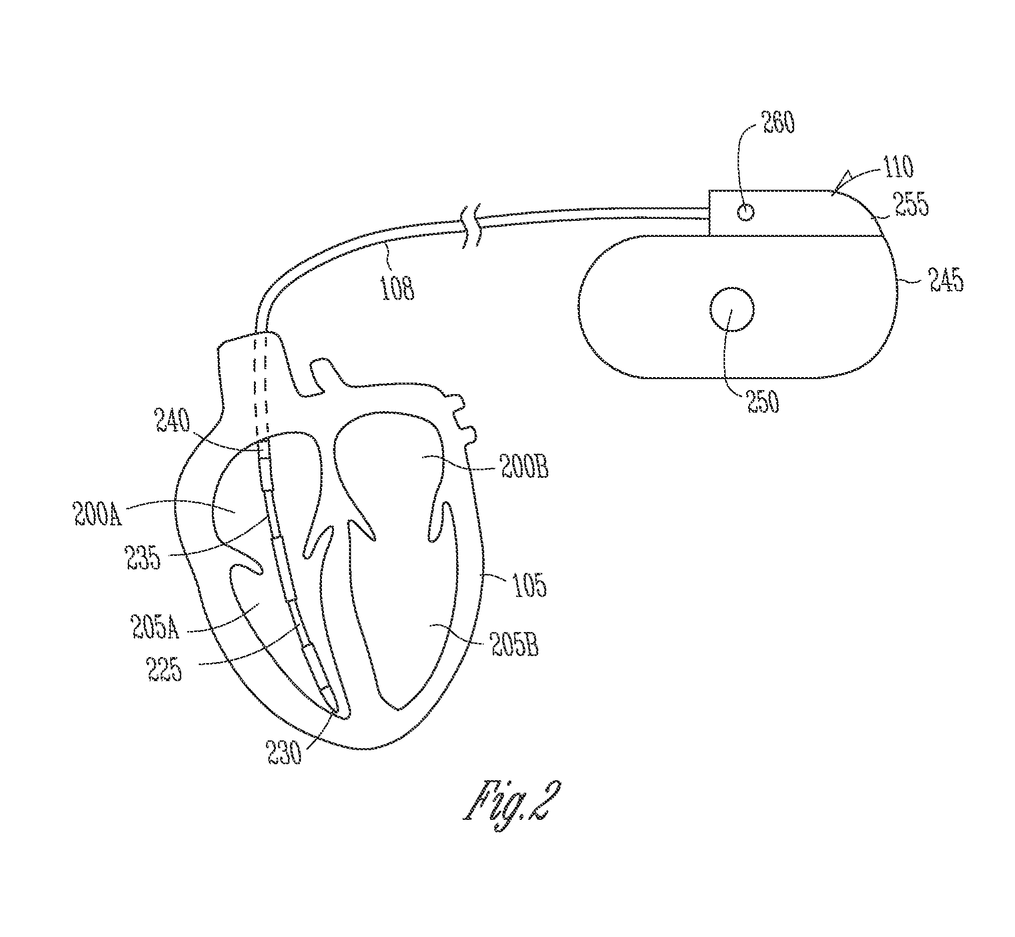 Heart attack or ischemia detector