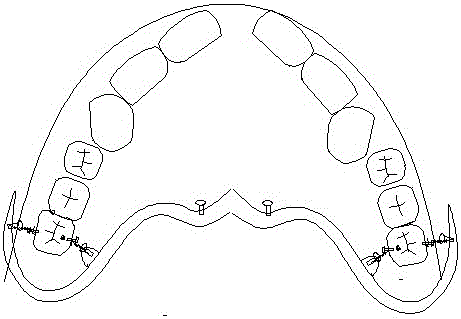 molar depressor