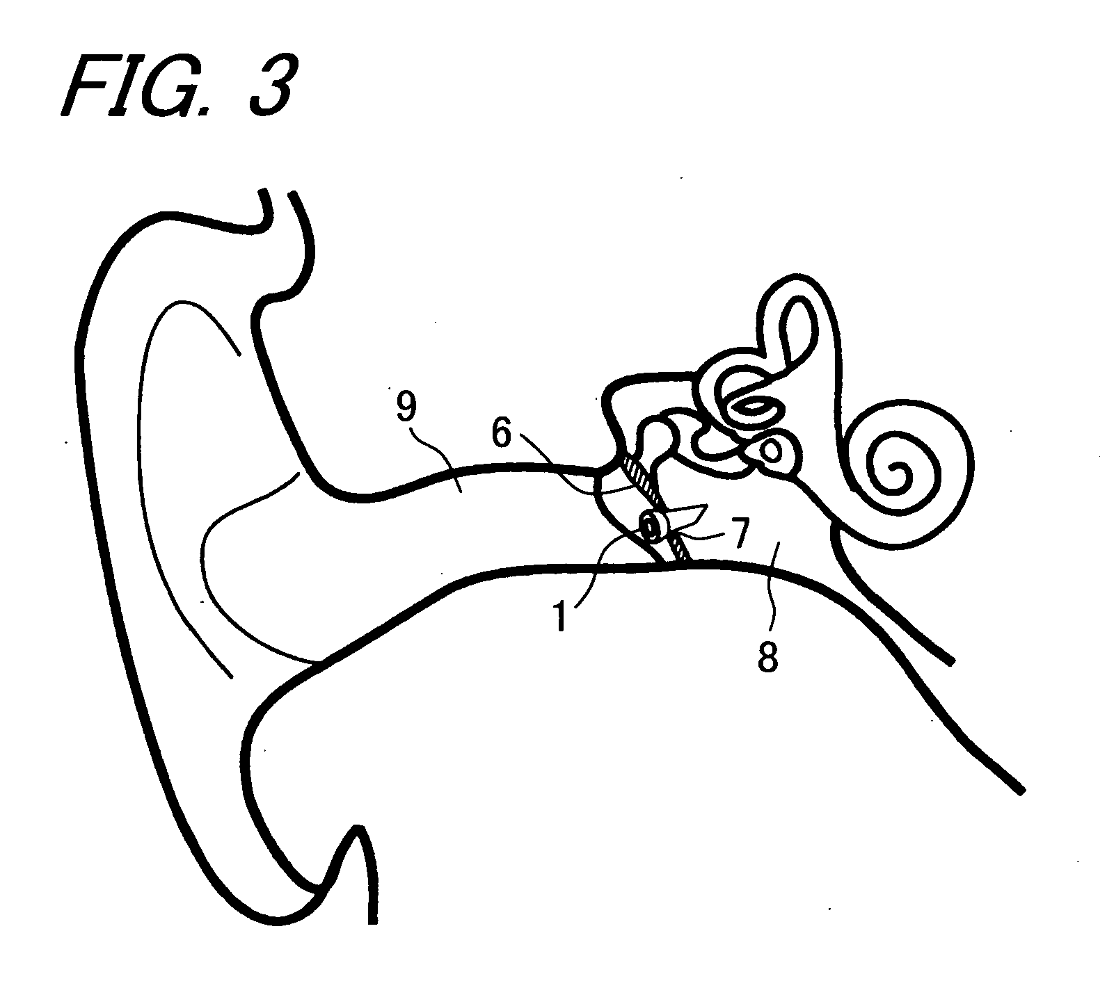 Tympanic membrane drain tube