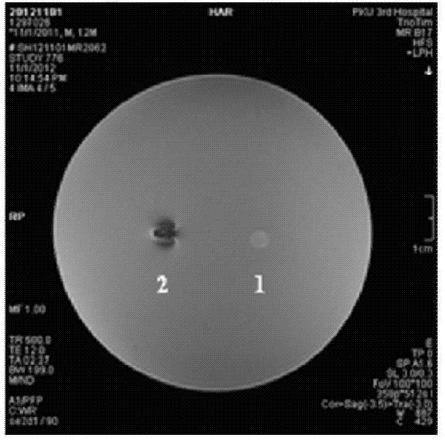 Magnetic resonance imaging detectable in-situ liquid crystal precursor embolism composition, preparation and application thereof