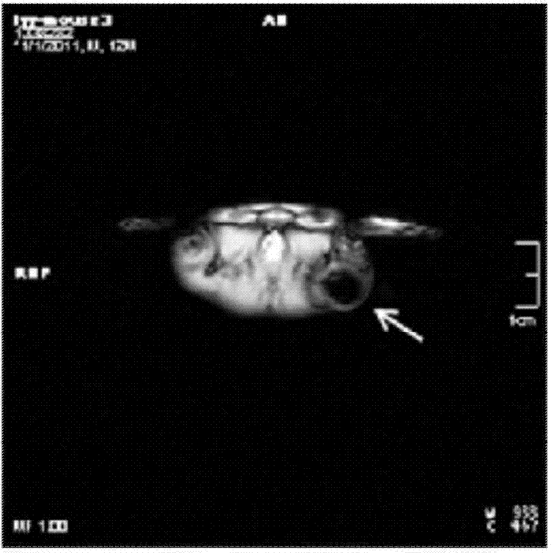 Magnetic resonance imaging detectable in-situ liquid crystal precursor embolism composition, preparation and application thereof