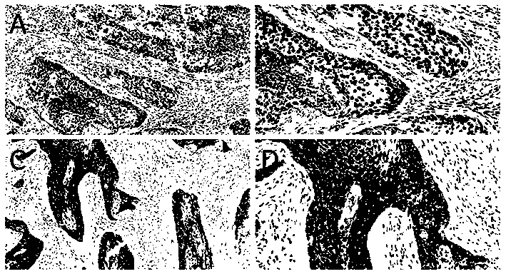 Application of UGT3A2 gene and protein coded by UGT3A2 gene in auxiliary diagnosis of upper gastrointestinal tumors