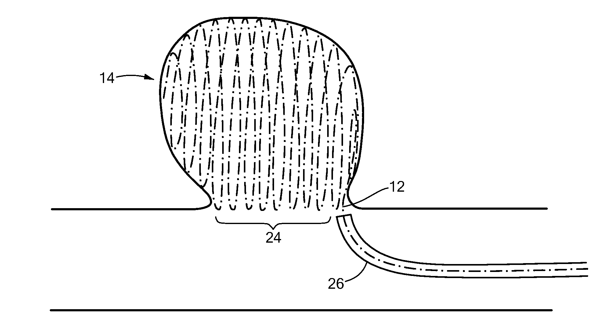 Spherical helix embolic coils for the treatment of cerebral aneurysms