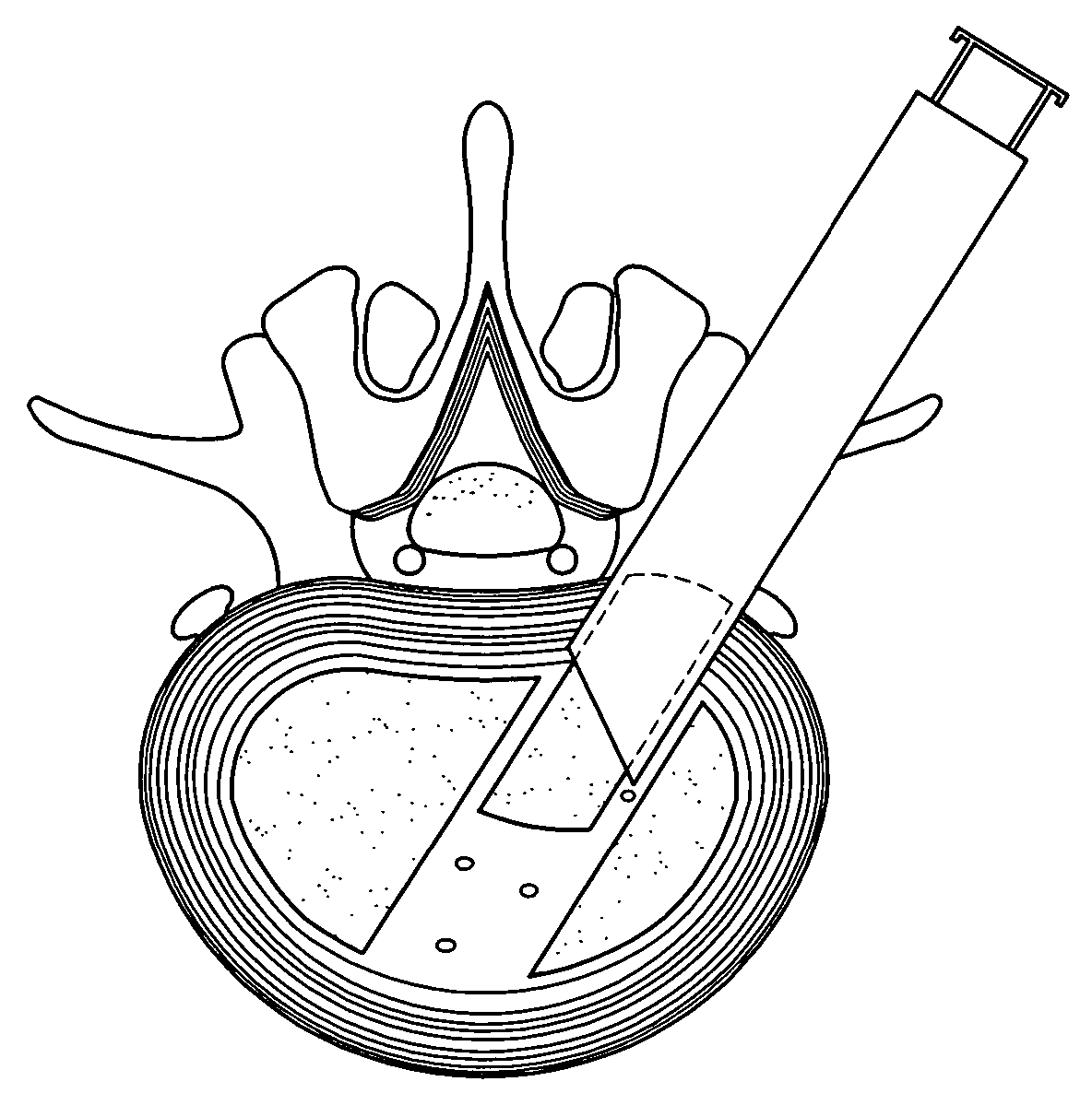 Implant material for minimally invasive spinal interbody fusion surgery