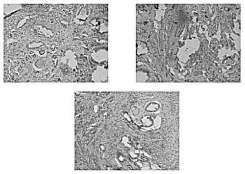 CircRNA relevant to prostatic cancers and application of circRNA