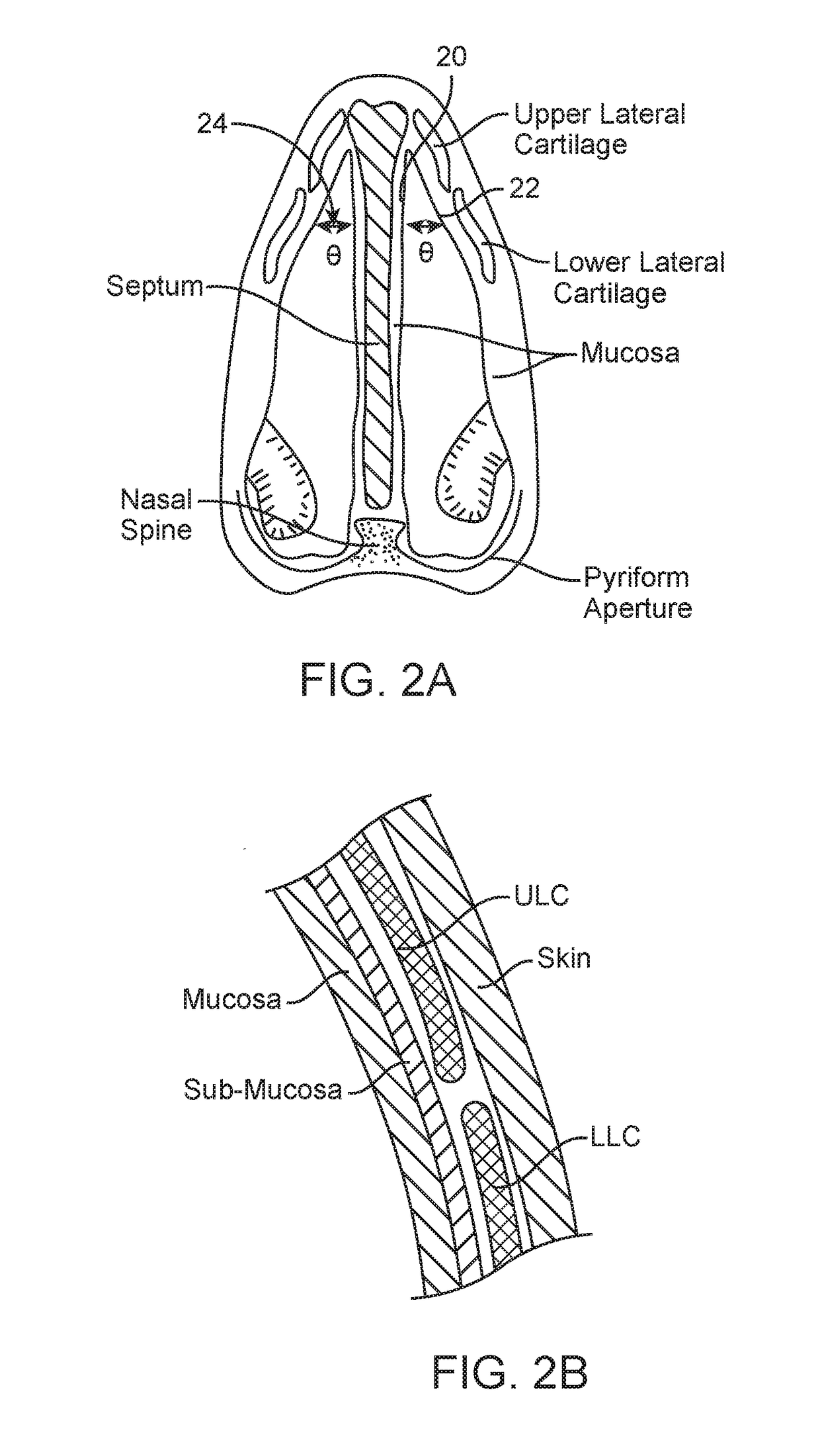 Methods and devices to treat nasal airways