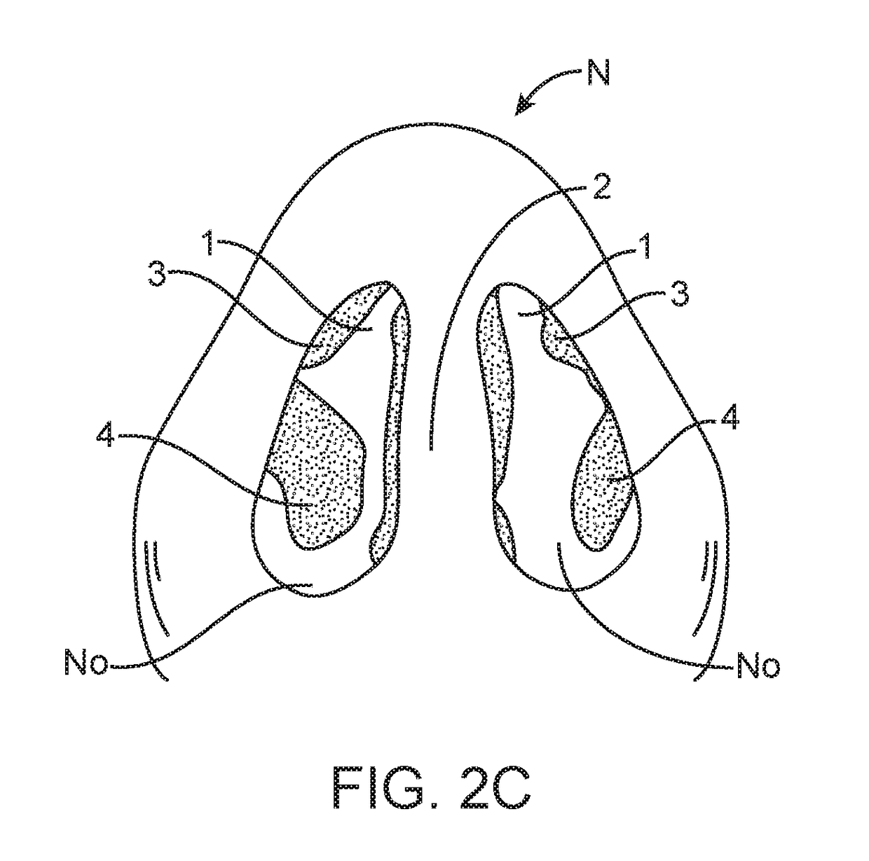 Methods and devices to treat nasal airways