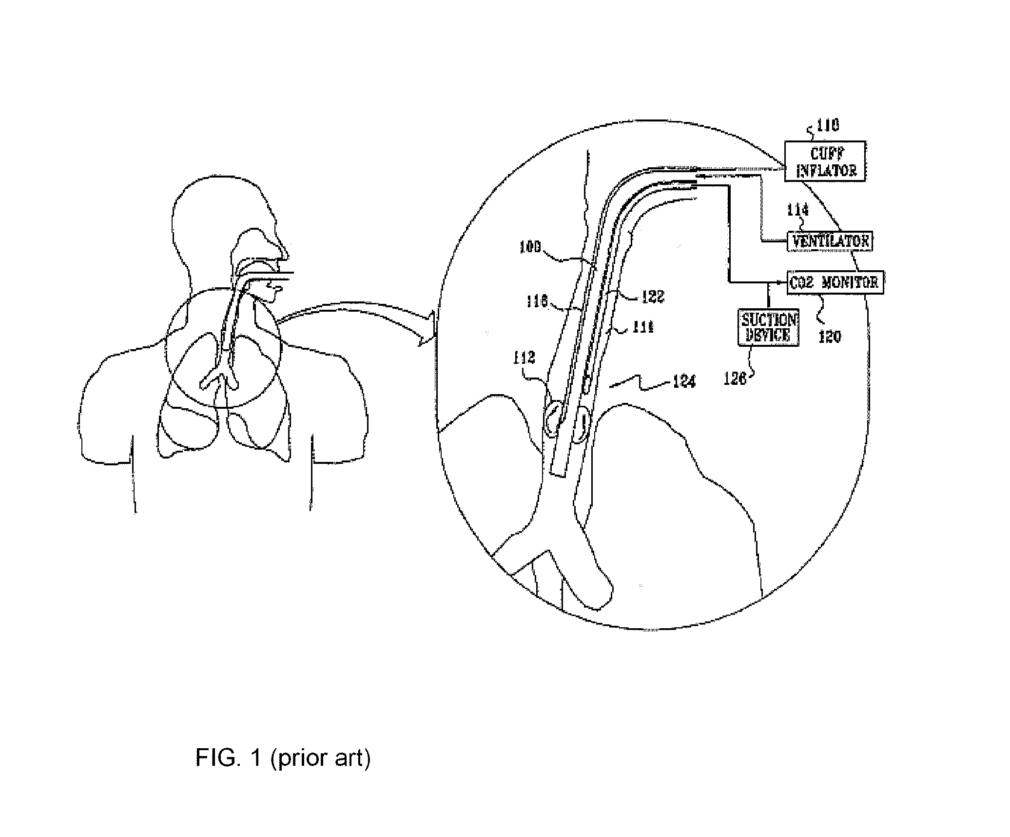 Method and apparatus for protection of trachea during ventilation