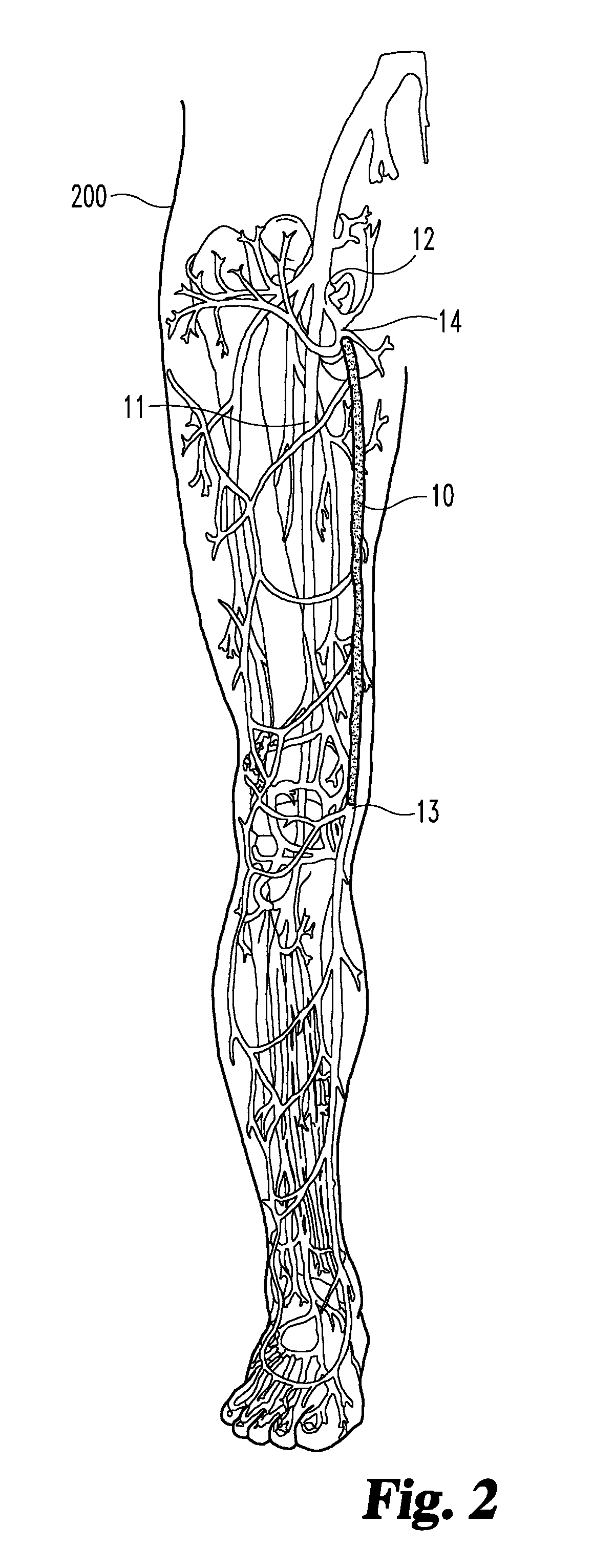 Methods for occluding bodily vessels