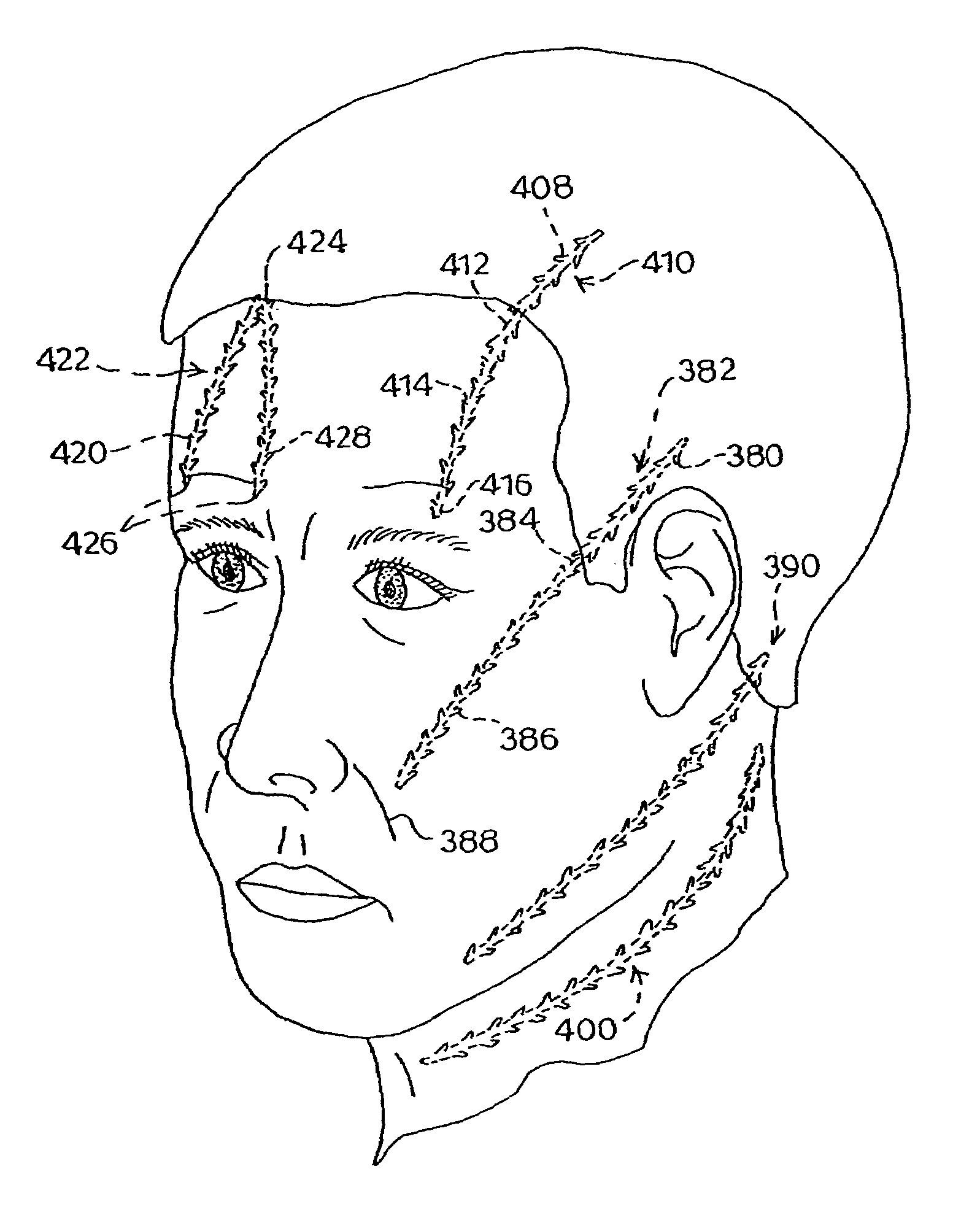 Suture method