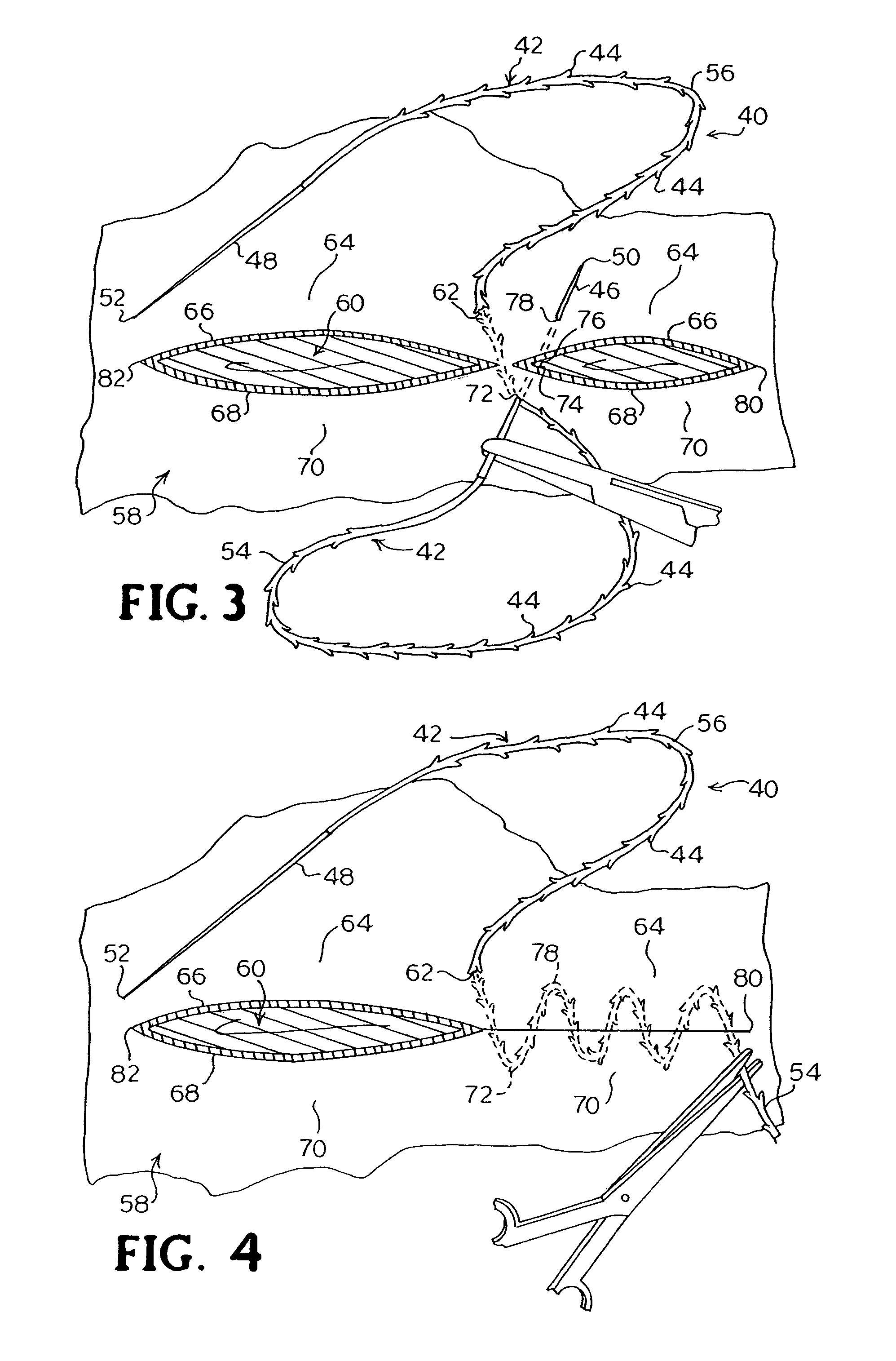 Suture method