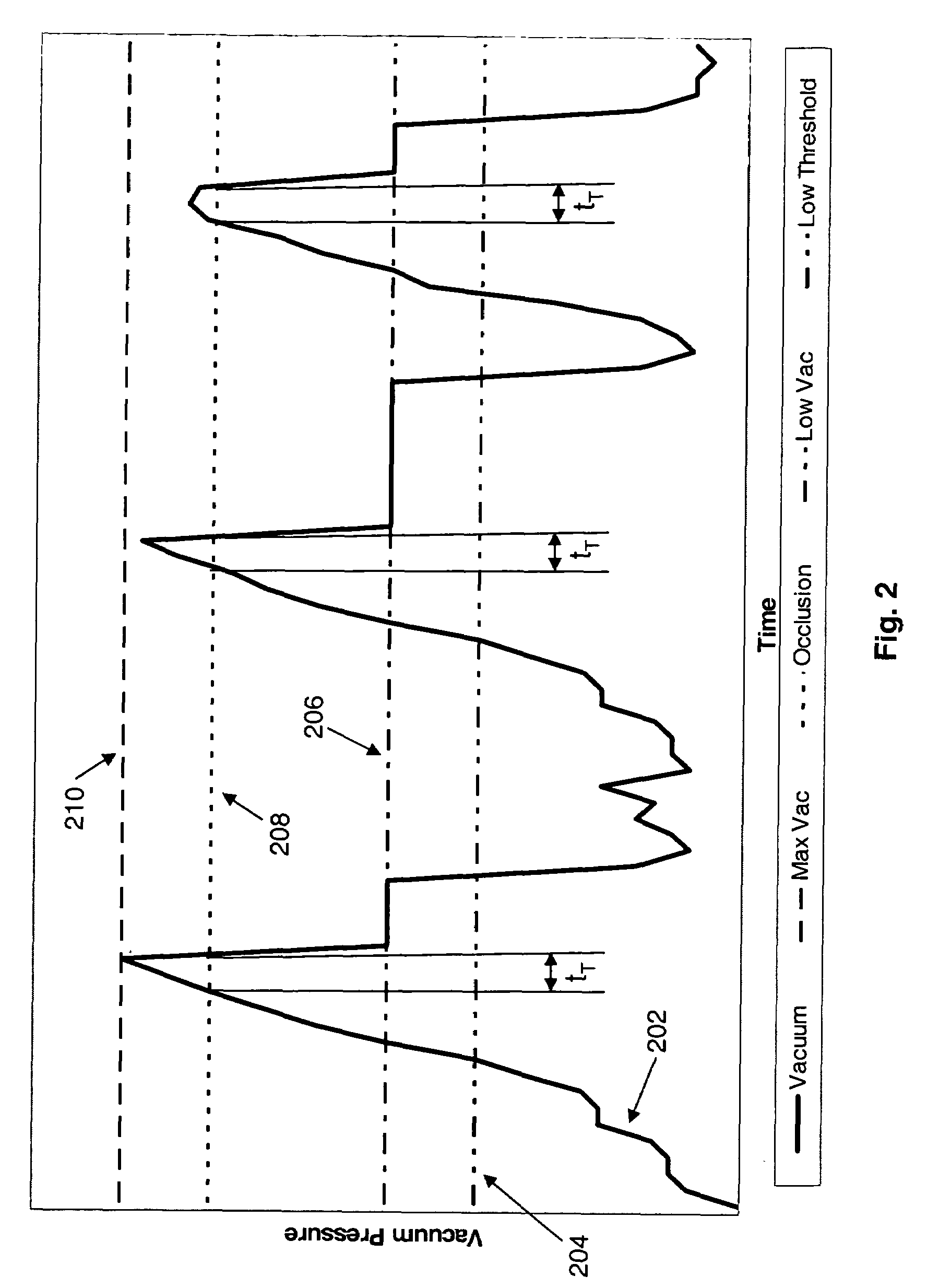 Application of vacuum as a method and mechanism for controlling eye chamber stability