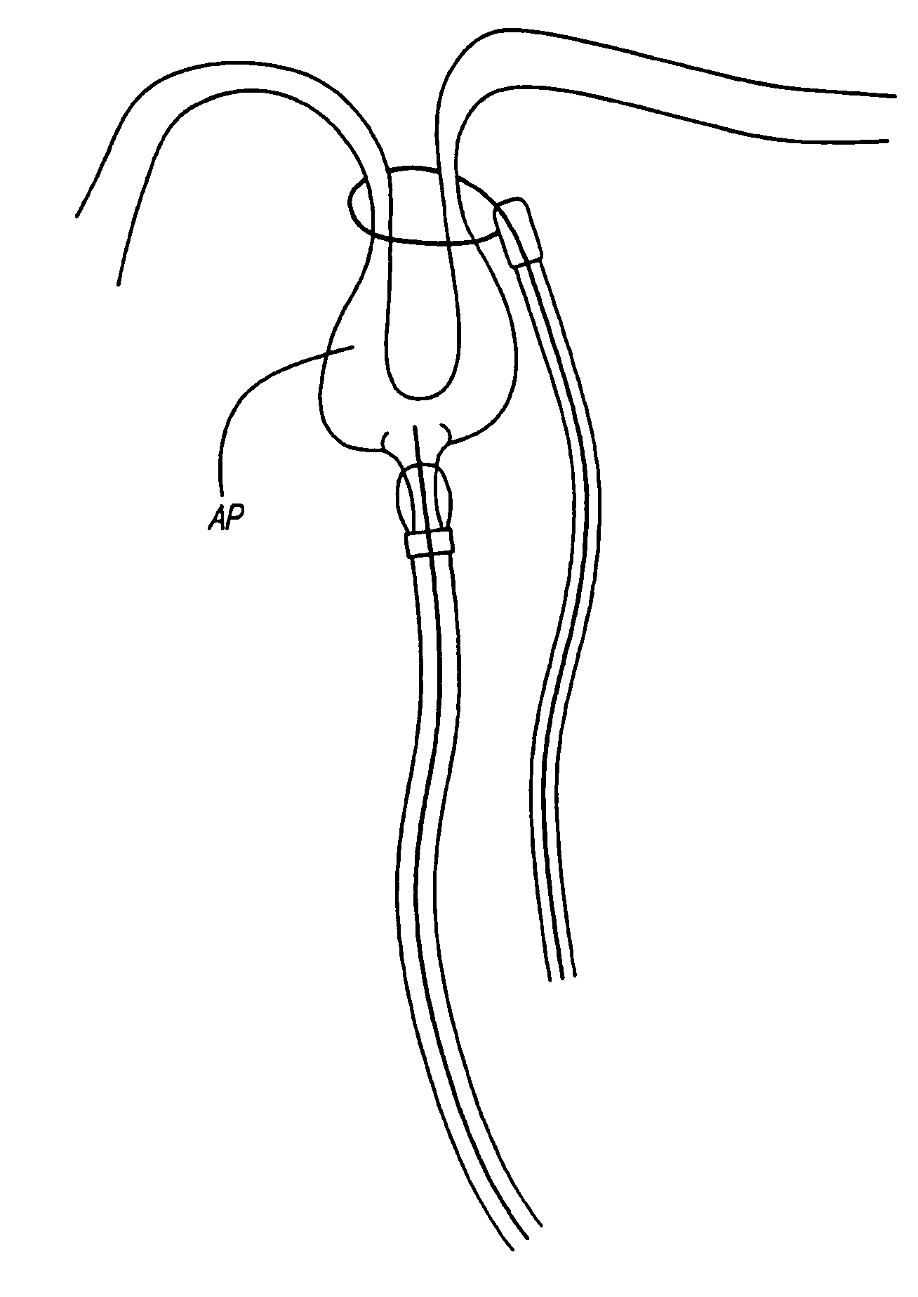 Surgical method and apparatus for positioning a diagnostic or therapeutic element within the body