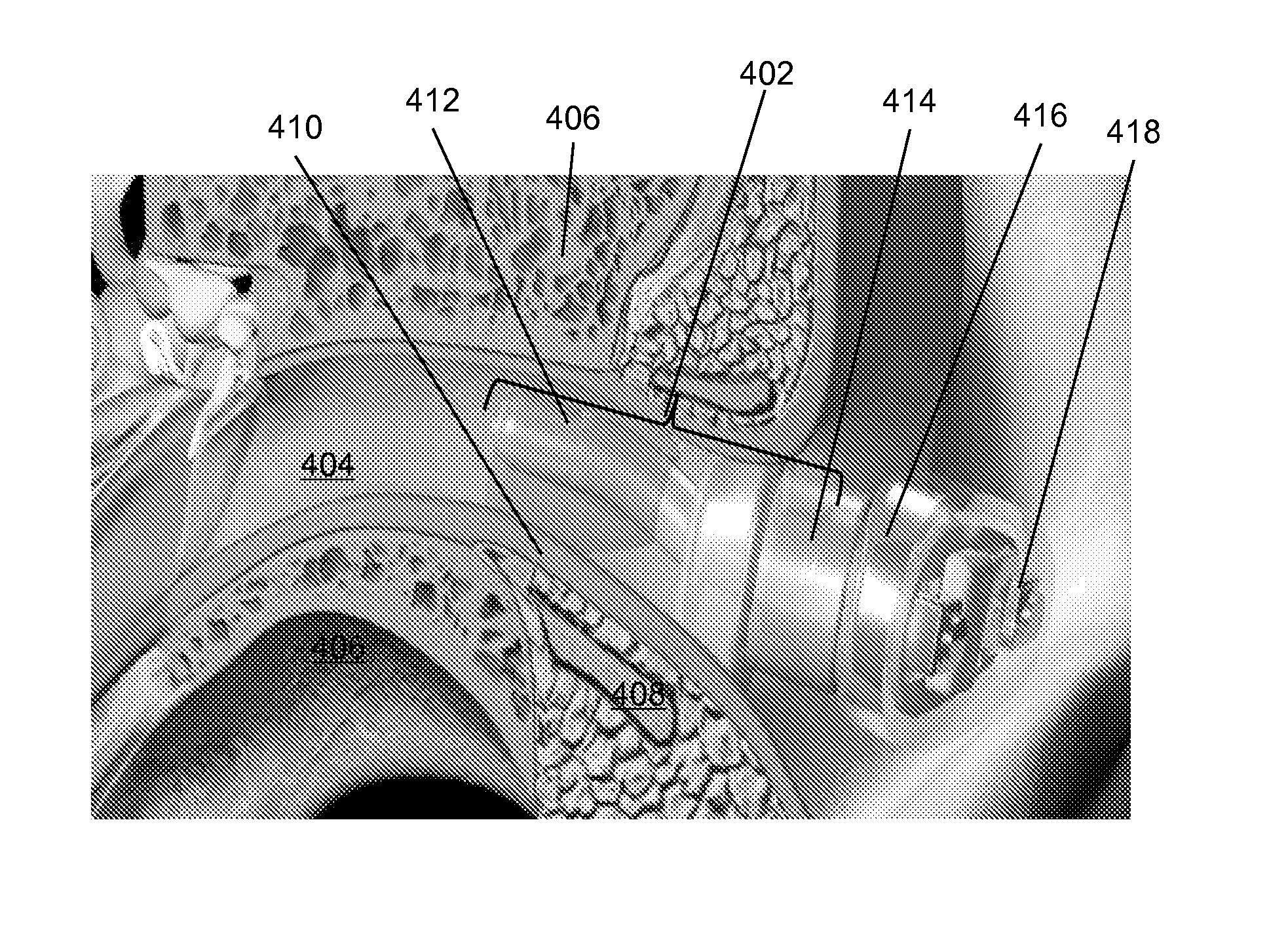 Method and device for acoustic sealing and occlusion effect mitigation