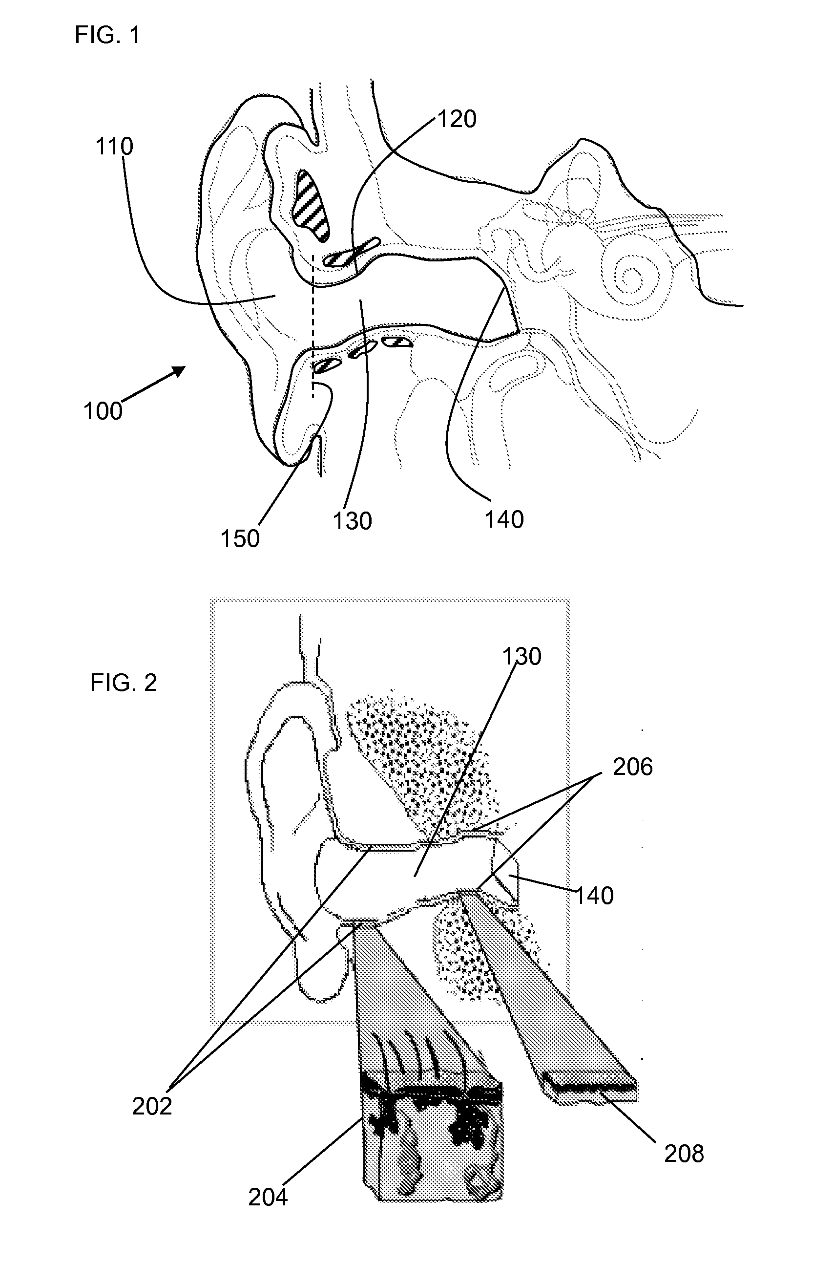 Method and device for acoustic sealing and occlusion effect mitigation