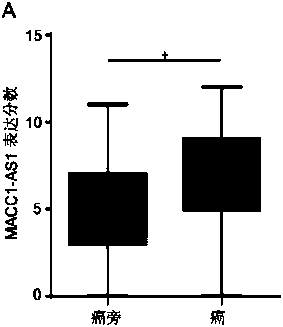 Application of MACC1-AS1 probe to preparation of diagnostic reagent for predicting clinical prognosis of gastric cancer