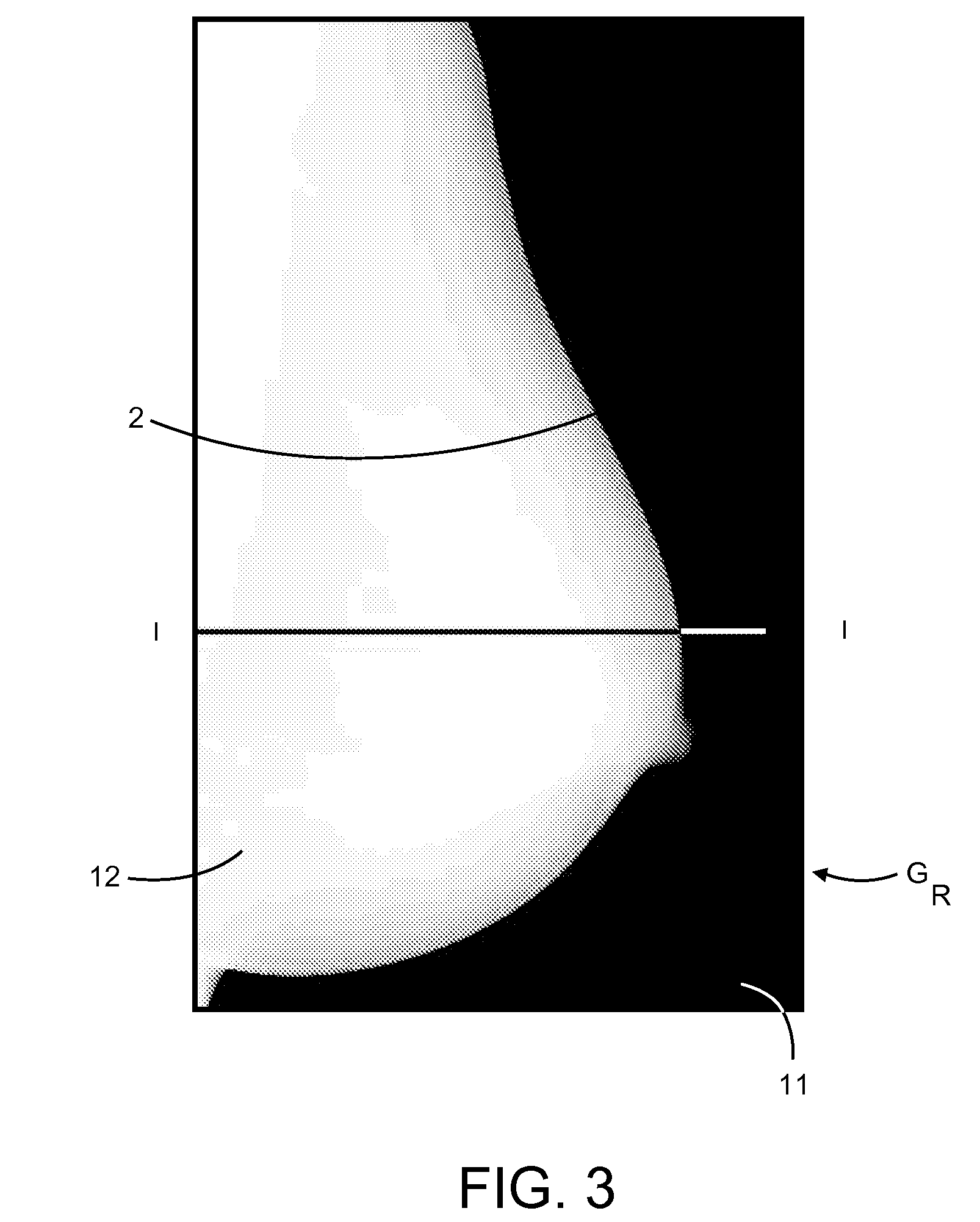 Method and Apparatus for Processing Digital Mammographic Images