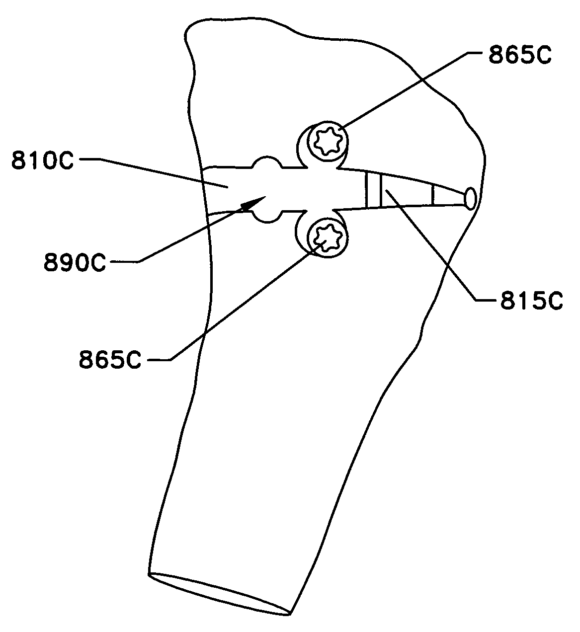 Method and apparatus for performing an open wedge, high tibial osteotomy