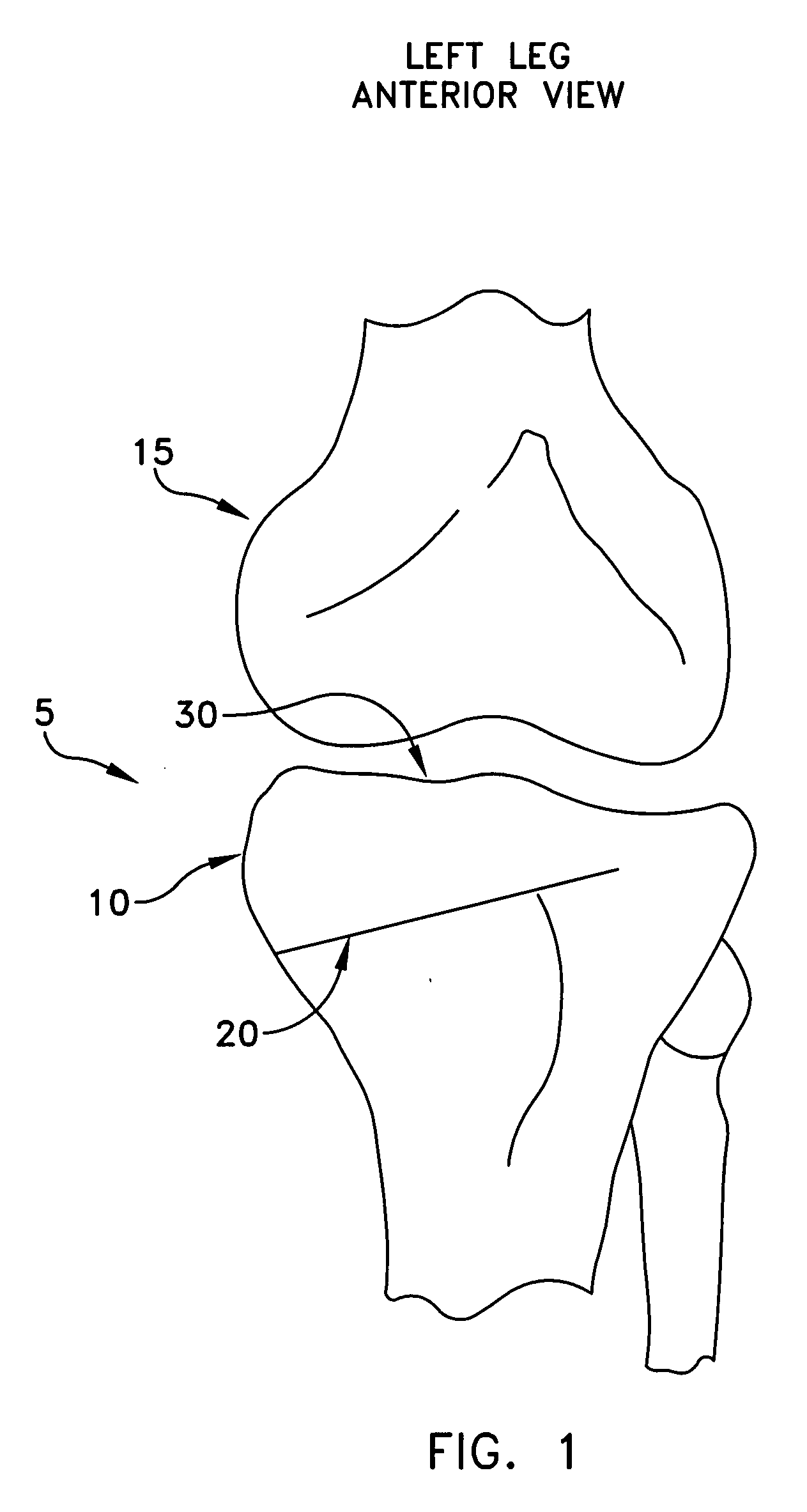 Method and apparatus for performing an open wedge, high tibial osteotomy