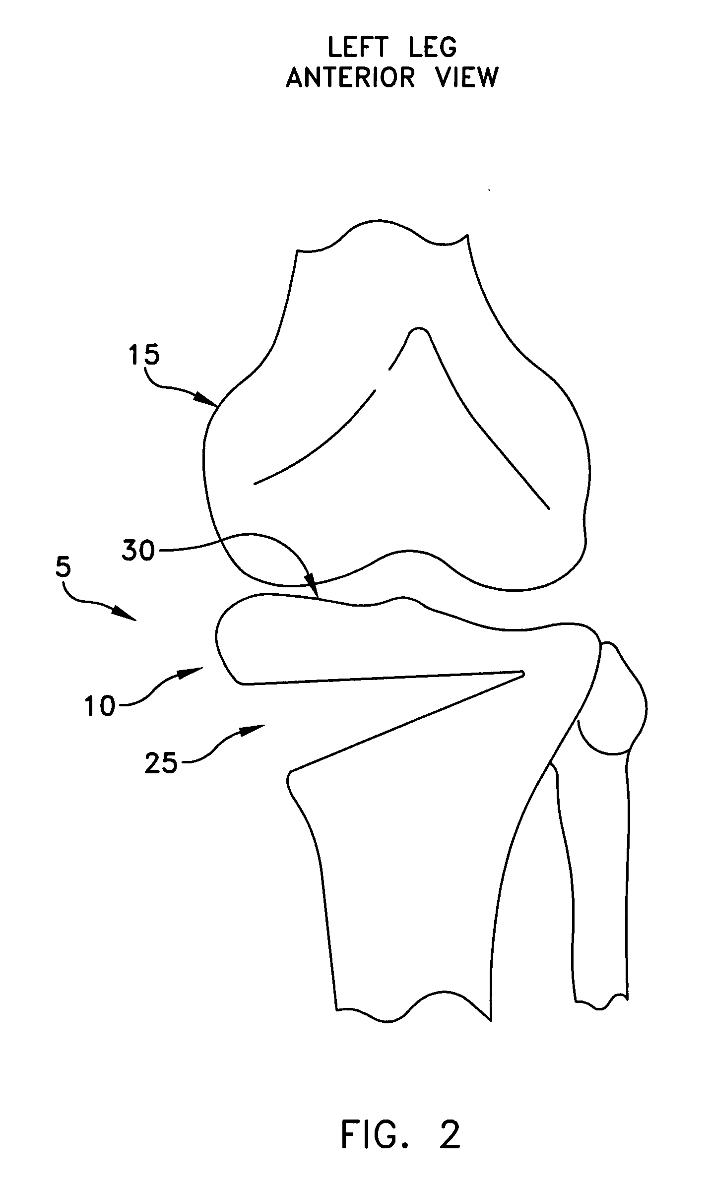 Method and apparatus for performing an open wedge, high tibial osteotomy