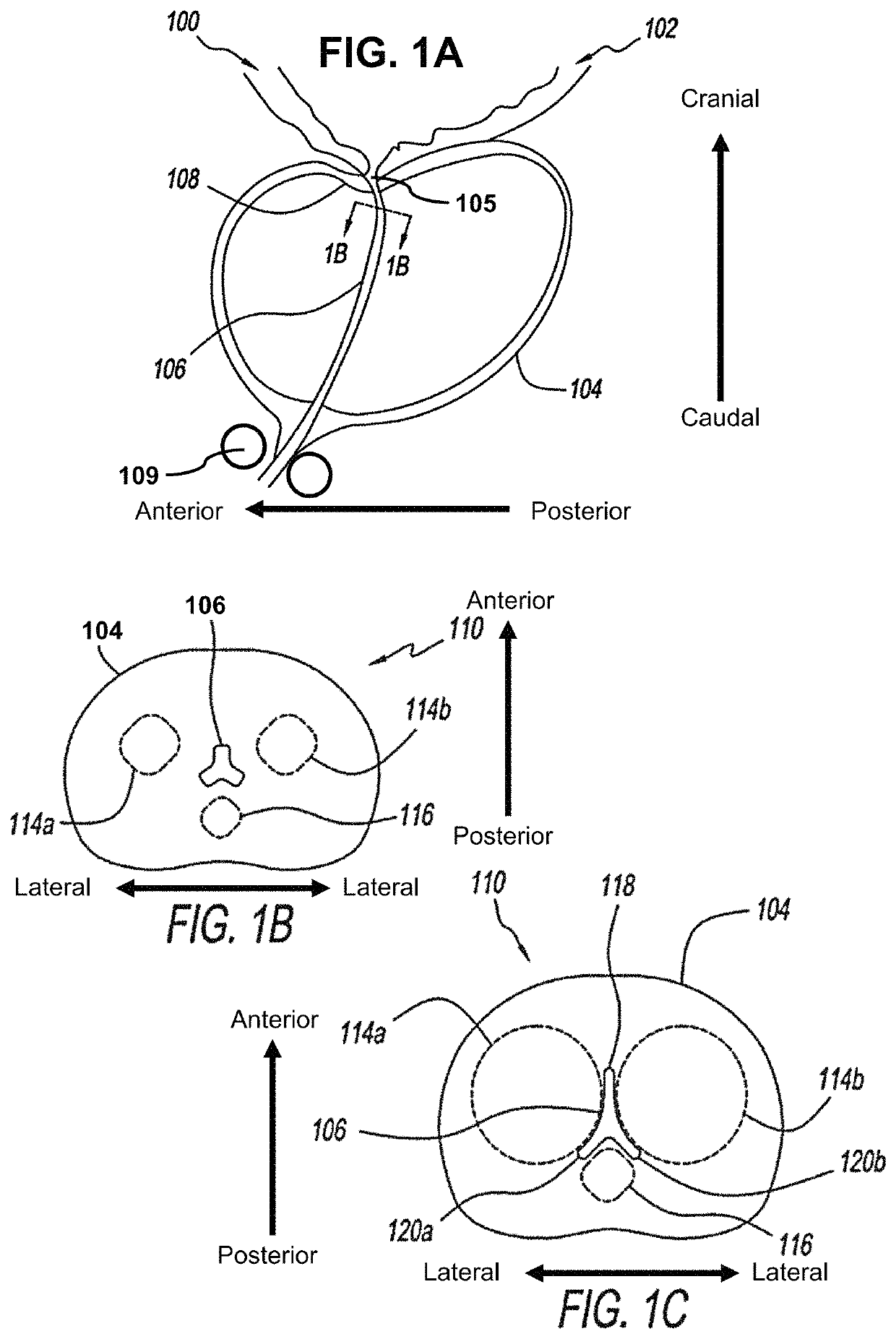 Dilating device and method for prostatic urethra