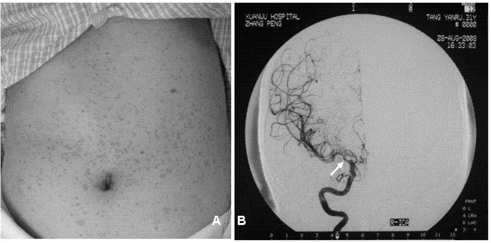 Kit for diagnosing cerebrovascular stenosis and application thereof