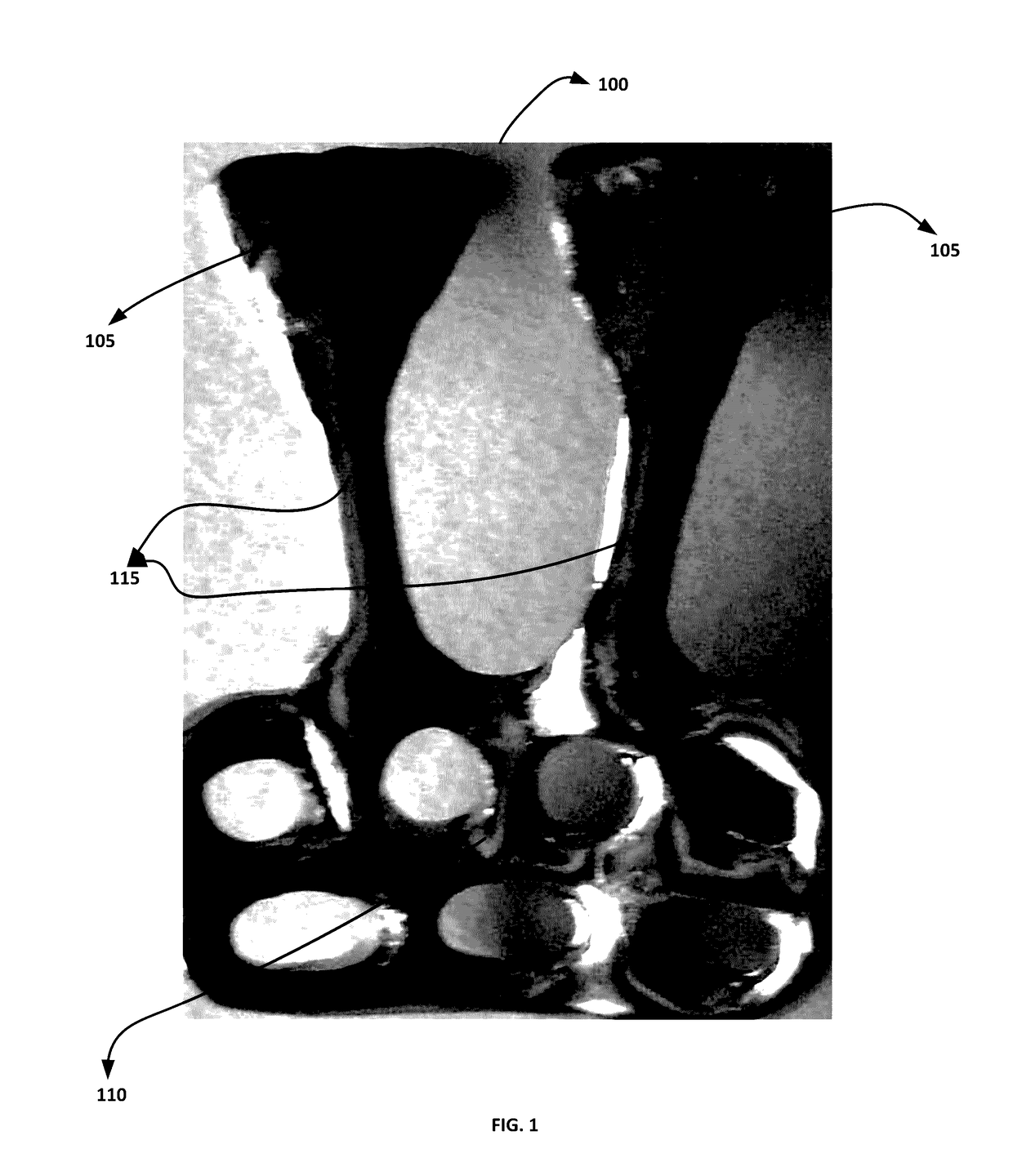 Orthodontic appliance for distalization and/or space closure