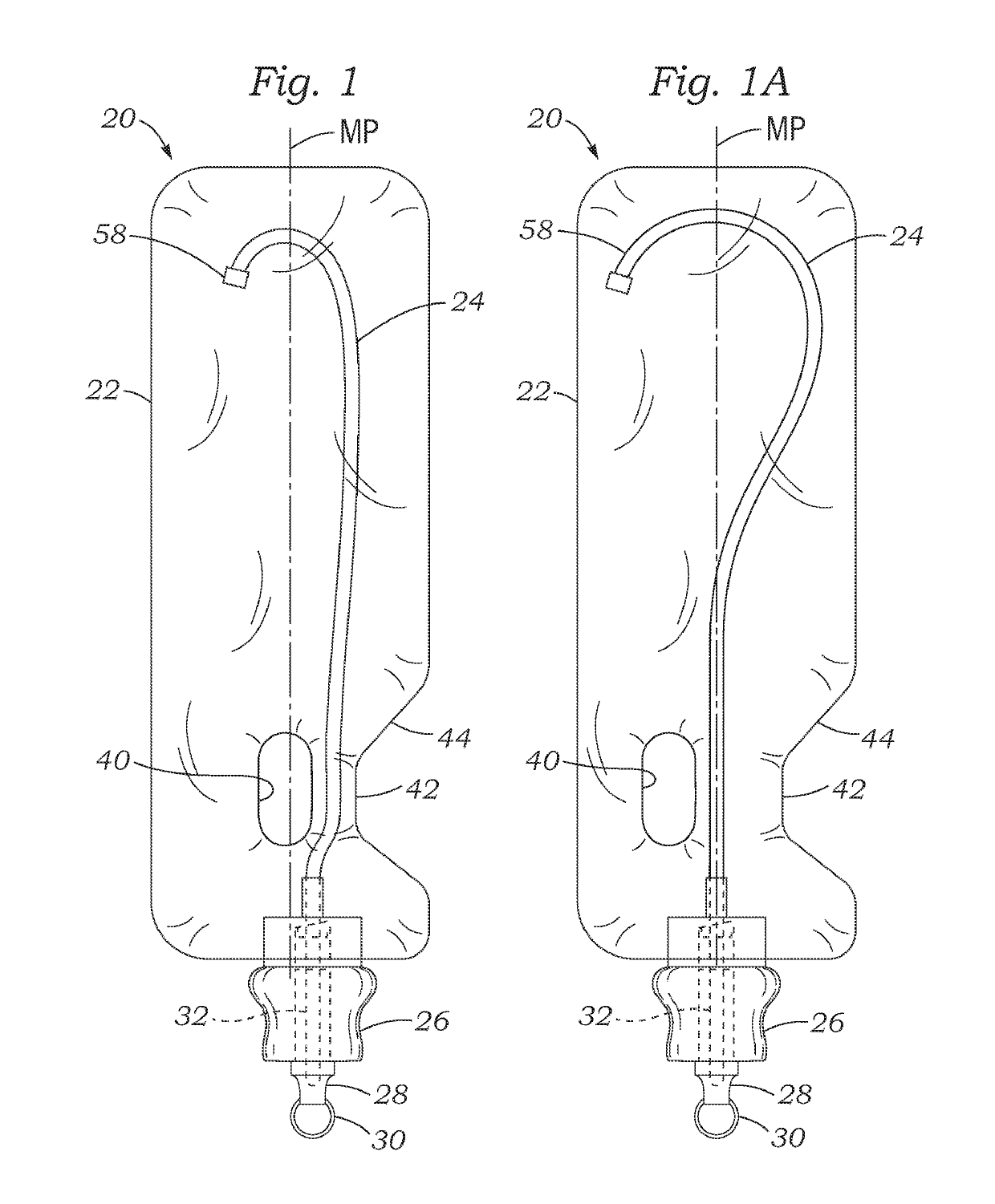 Closed system with intermittent urinary catheter feed