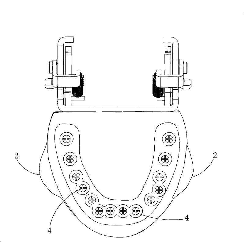 Alveolar abscess cut model