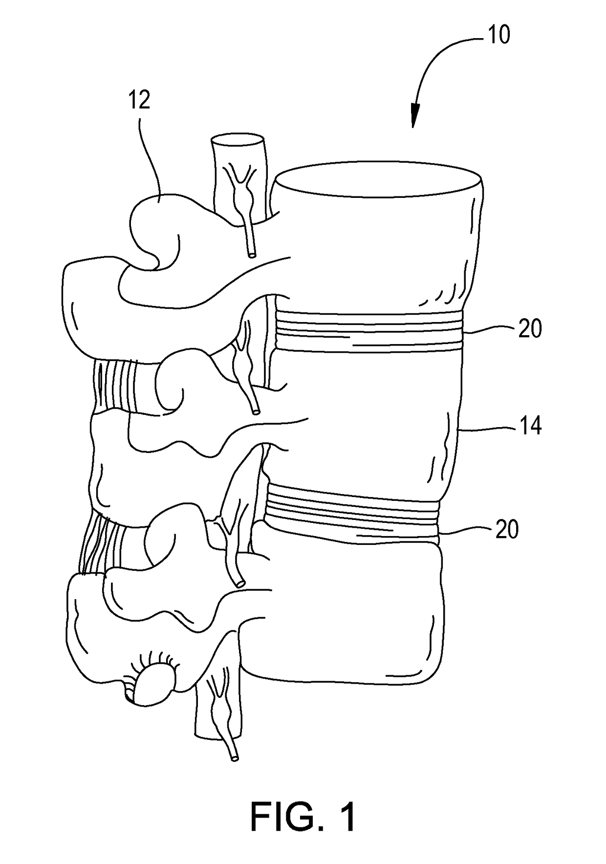 Anterior lumbar fusion method and device