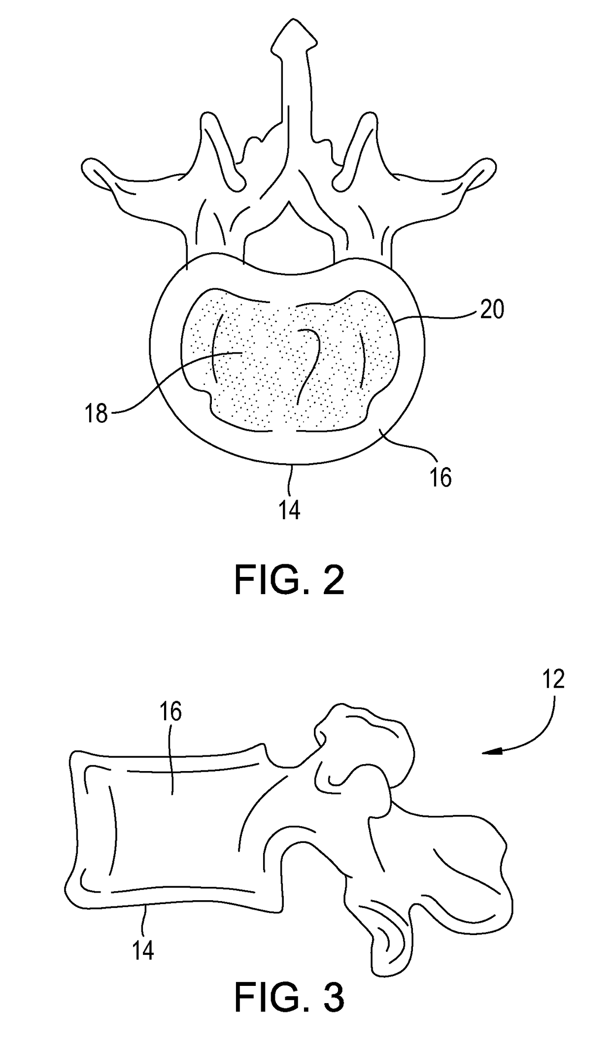 Anterior lumbar fusion method and device