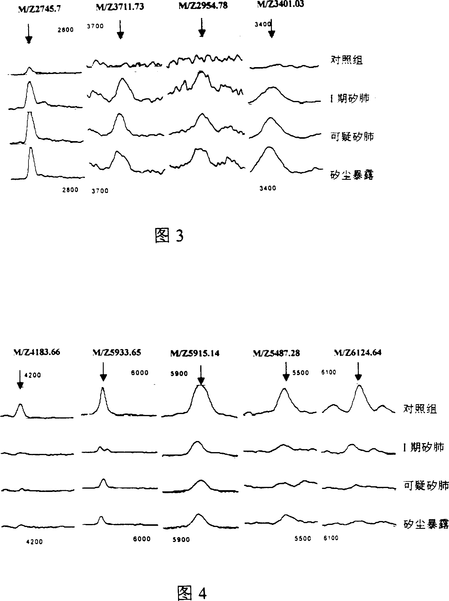 Constitution method for silicosis peope serum protein finger print