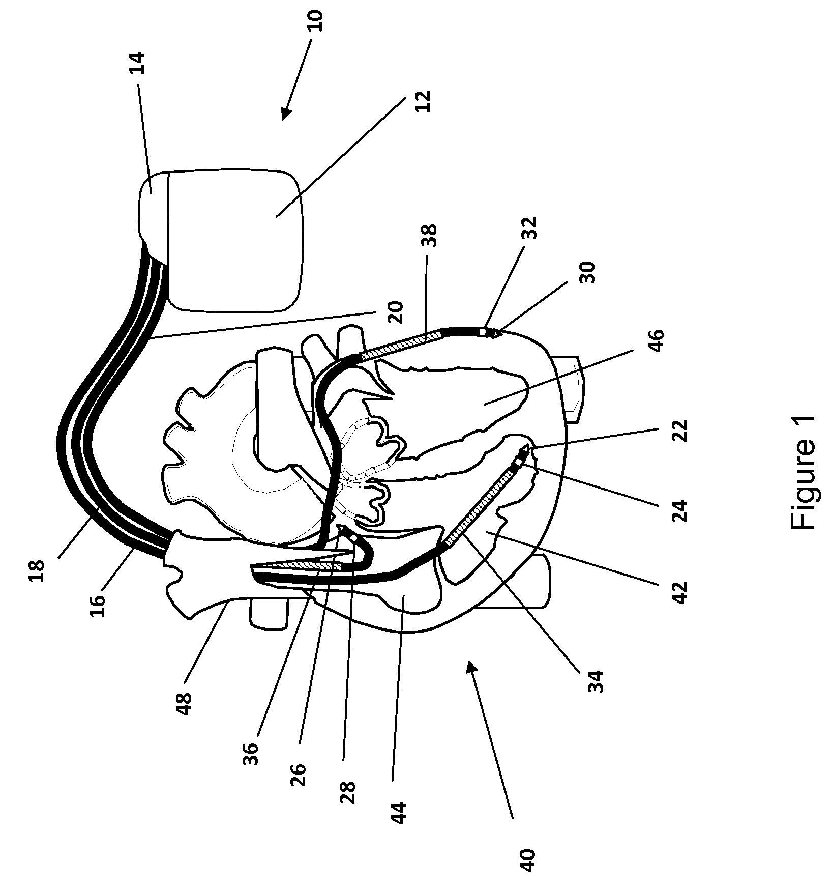 Device and method for fusion beat detection