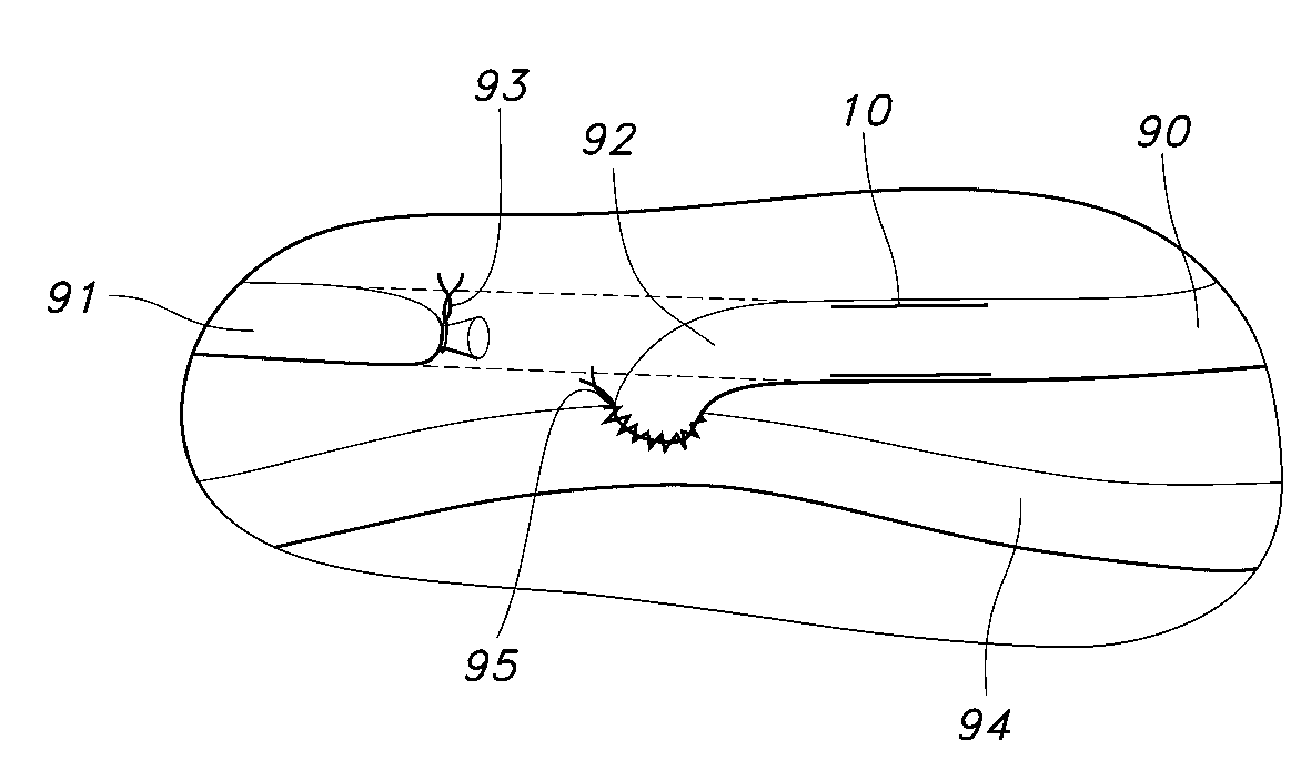 Blood acess apparatus and method