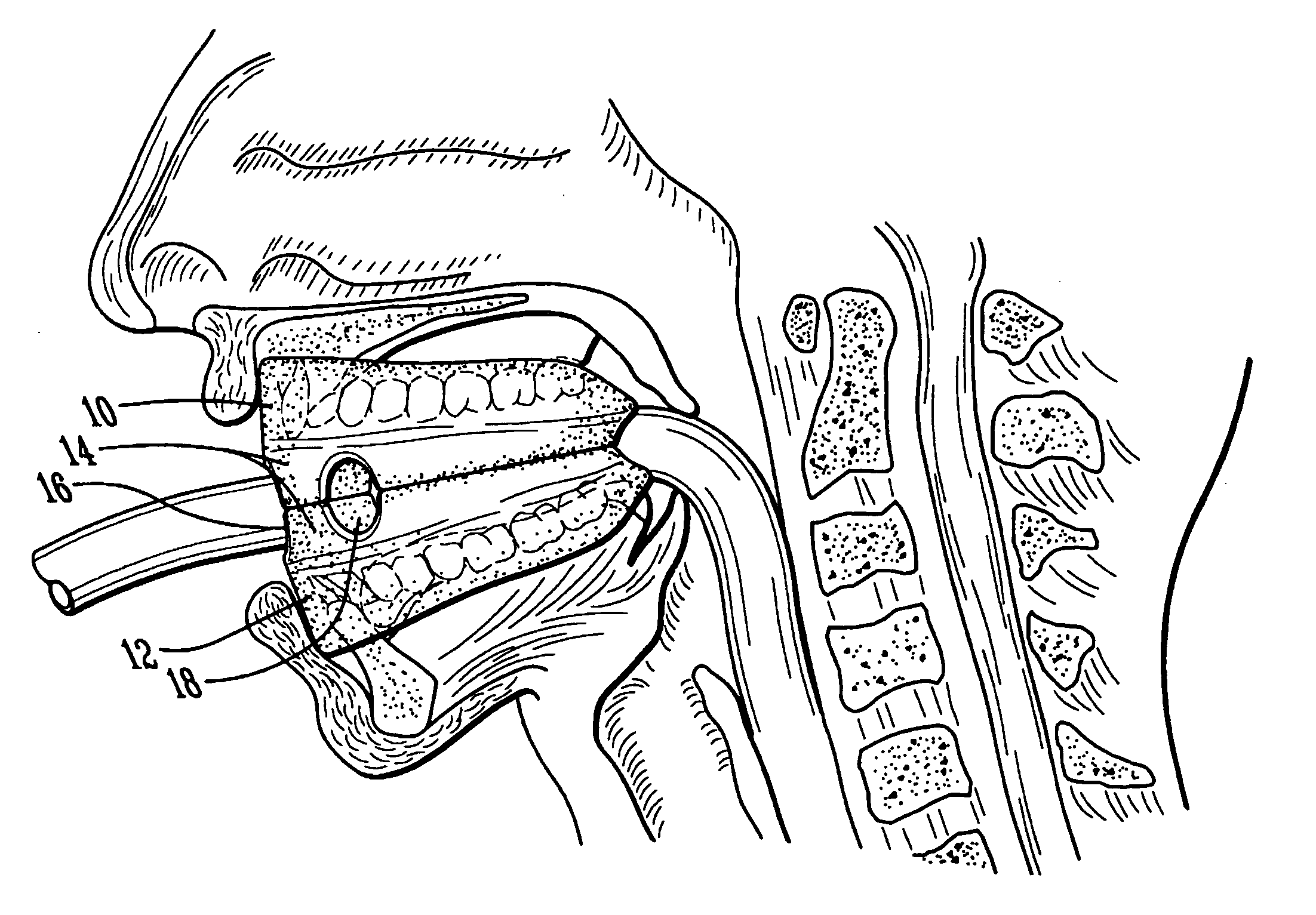 Mouth guard