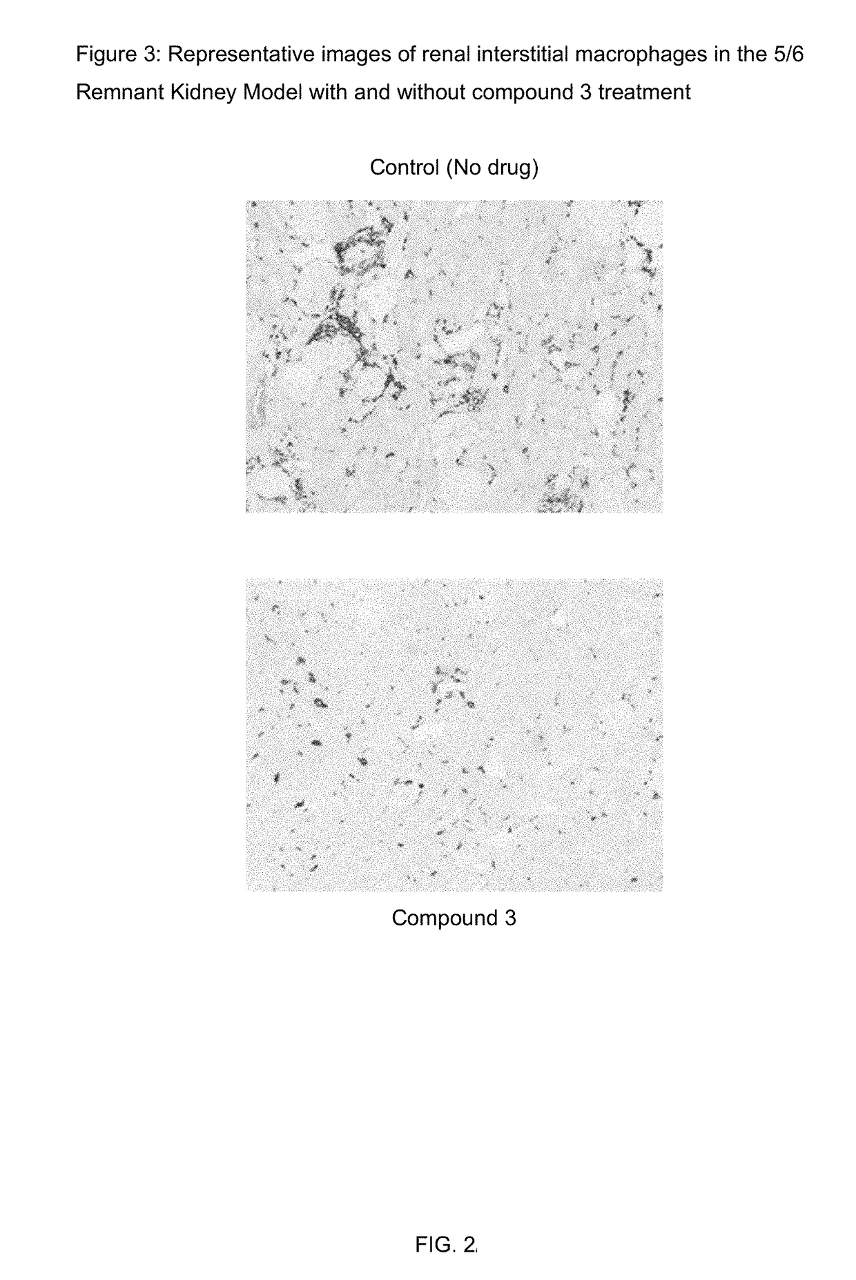 Method of treating focal segmental glomerulosclerosis