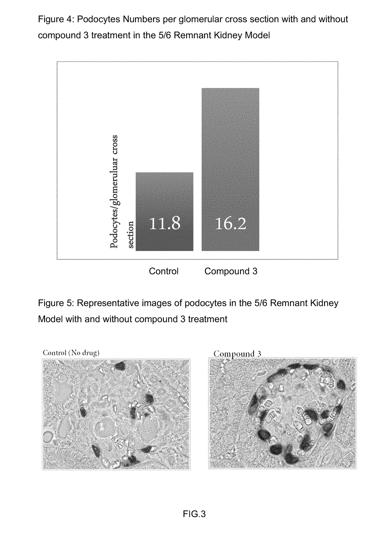 Method of treating focal segmental glomerulosclerosis