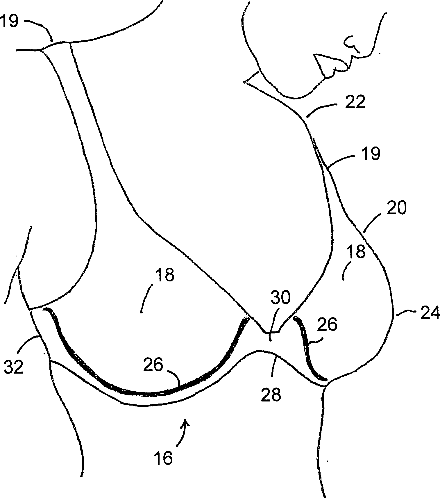 Postoperative bilateral augmentation mammaplasty brassiere