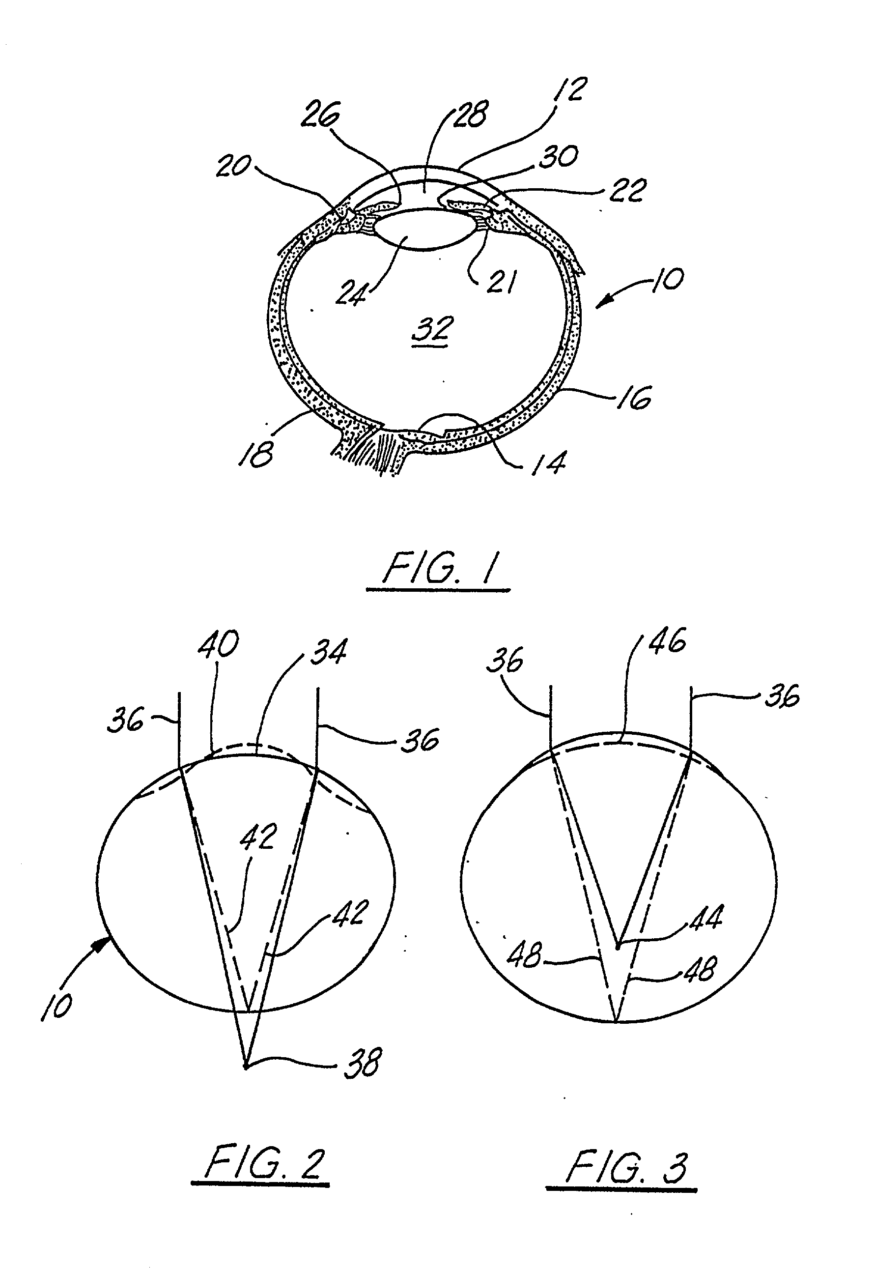 Corneal implant and method of manufacture