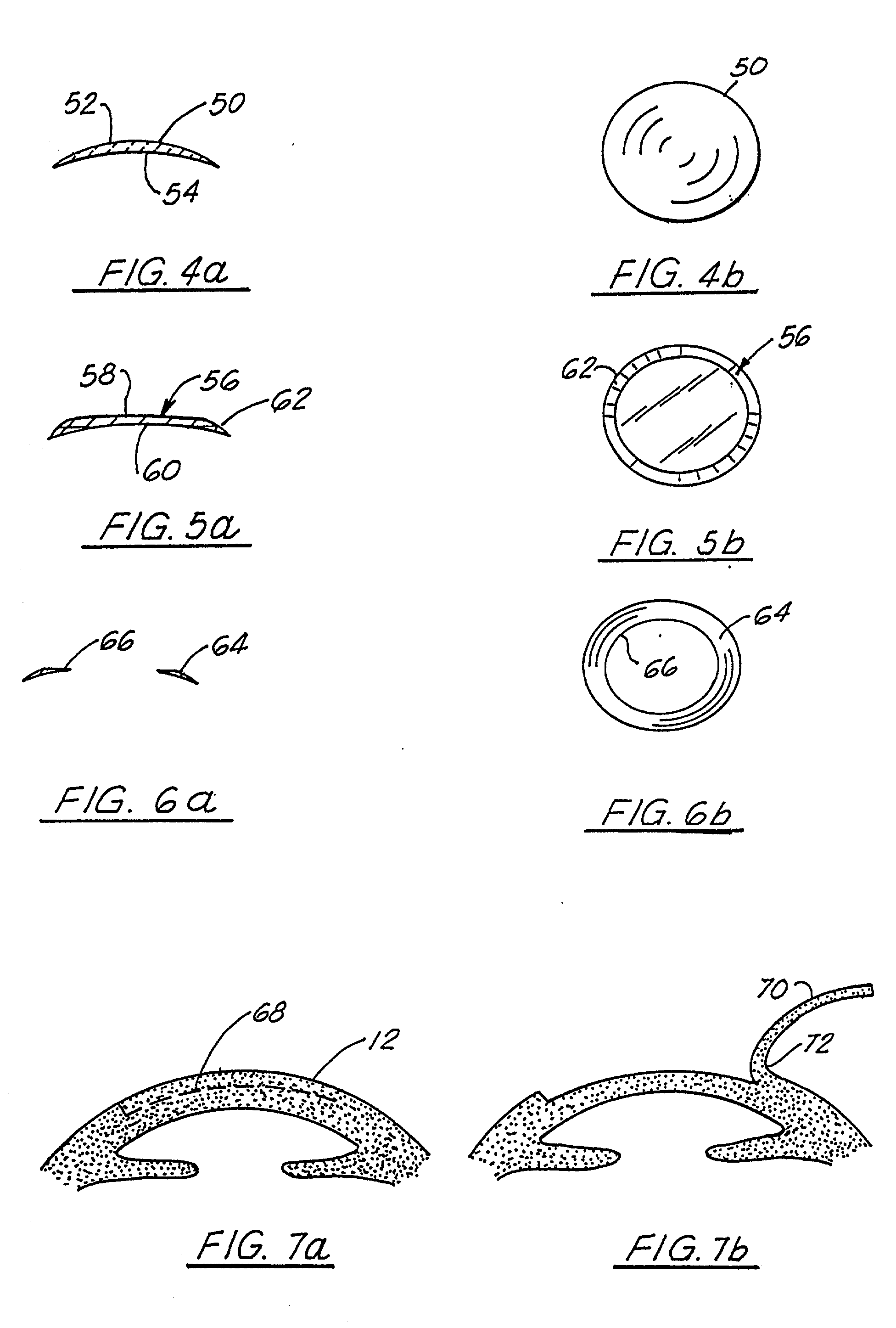 Corneal implant and method of manufacture