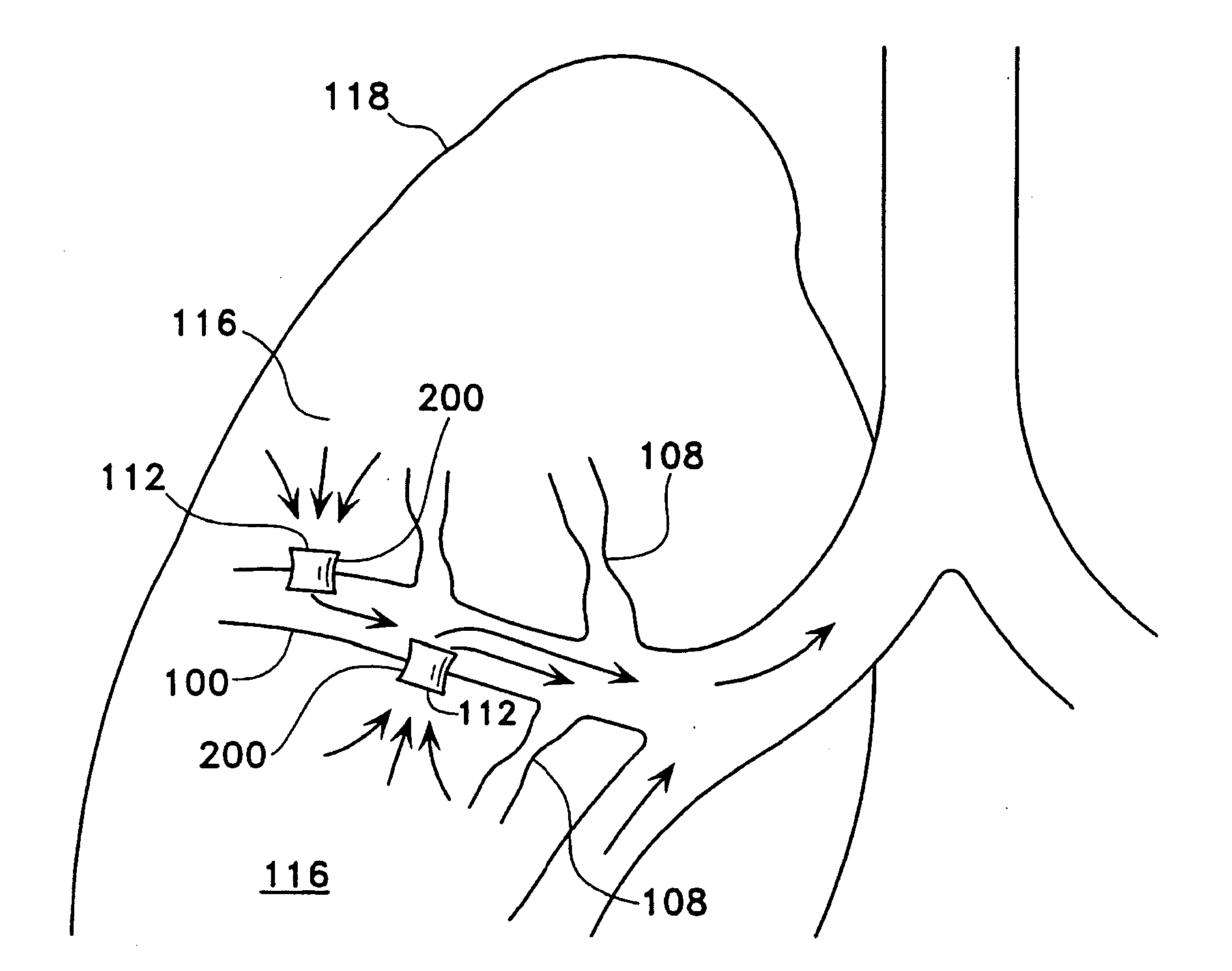 Methods for maintaining the patency of collateral channels in the lungs using cryo-energy