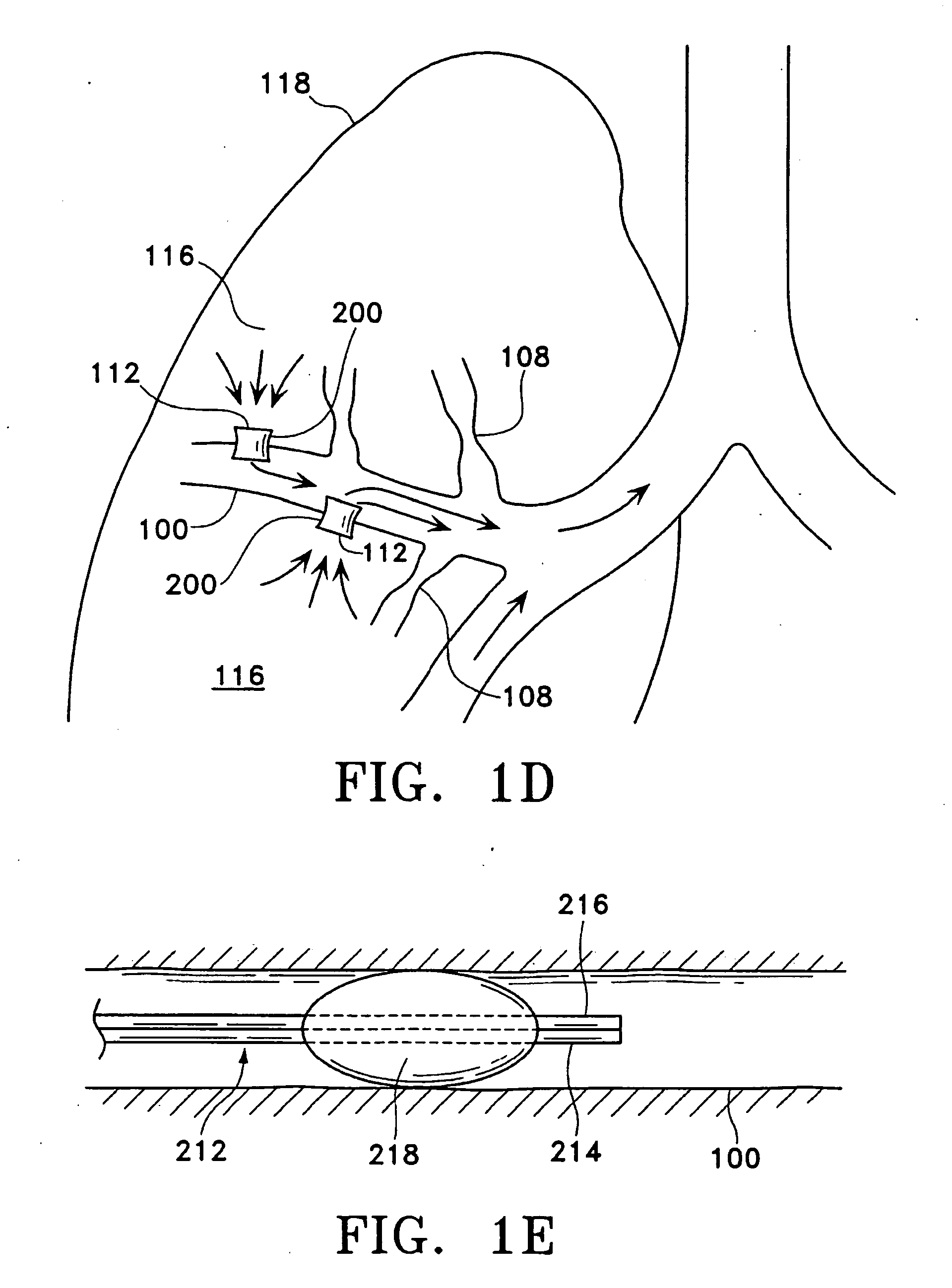 Methods for maintaining the patency of collateral channels in the lungs using cryo-energy