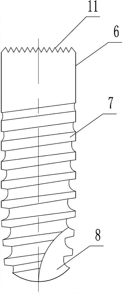 Assembled dental implant