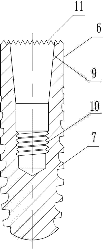 Assembled dental implant