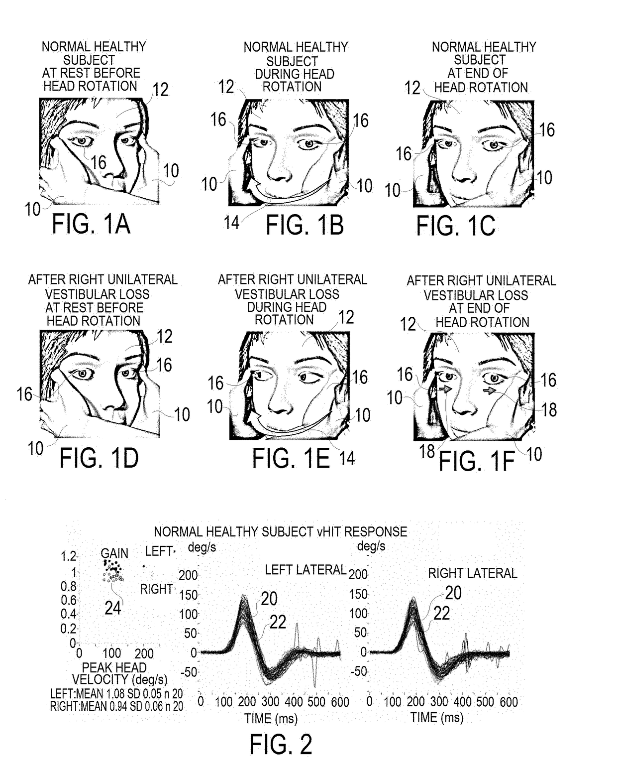 Apparatus and Method for Computerized Rotational Head Impulse Test