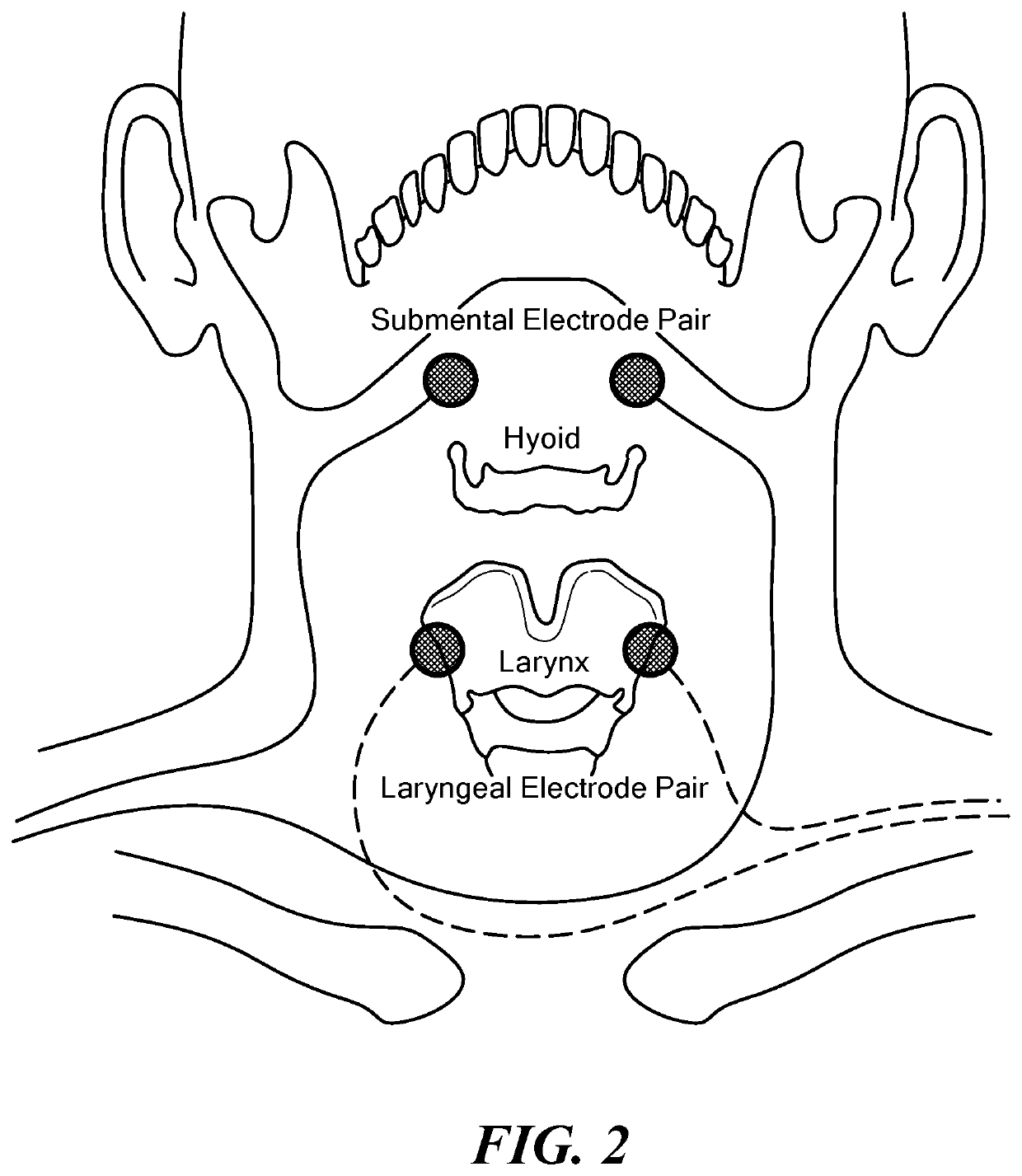 Eliciting Swallowing using Electrical Stimulation Applied via Surface Electrodes