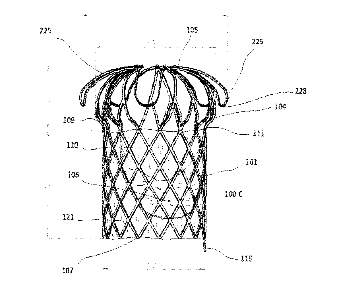 Transcatheter Pulmonary Ball Valve Assembly