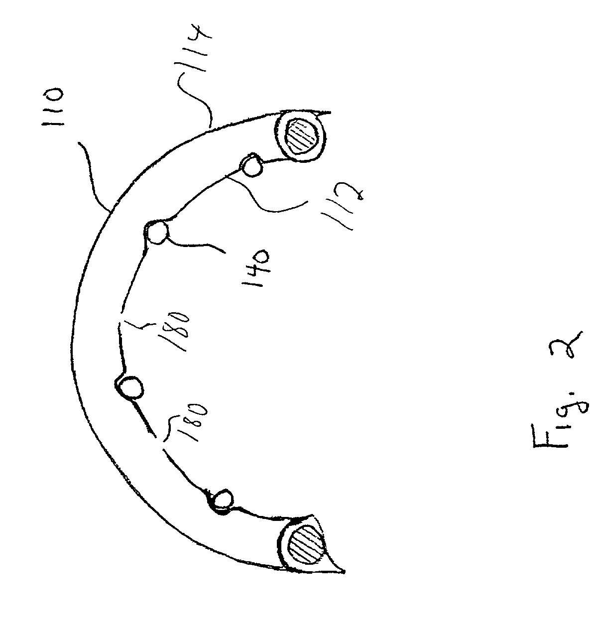 Implant having improved fixation to a body lumen and method for implanting the same