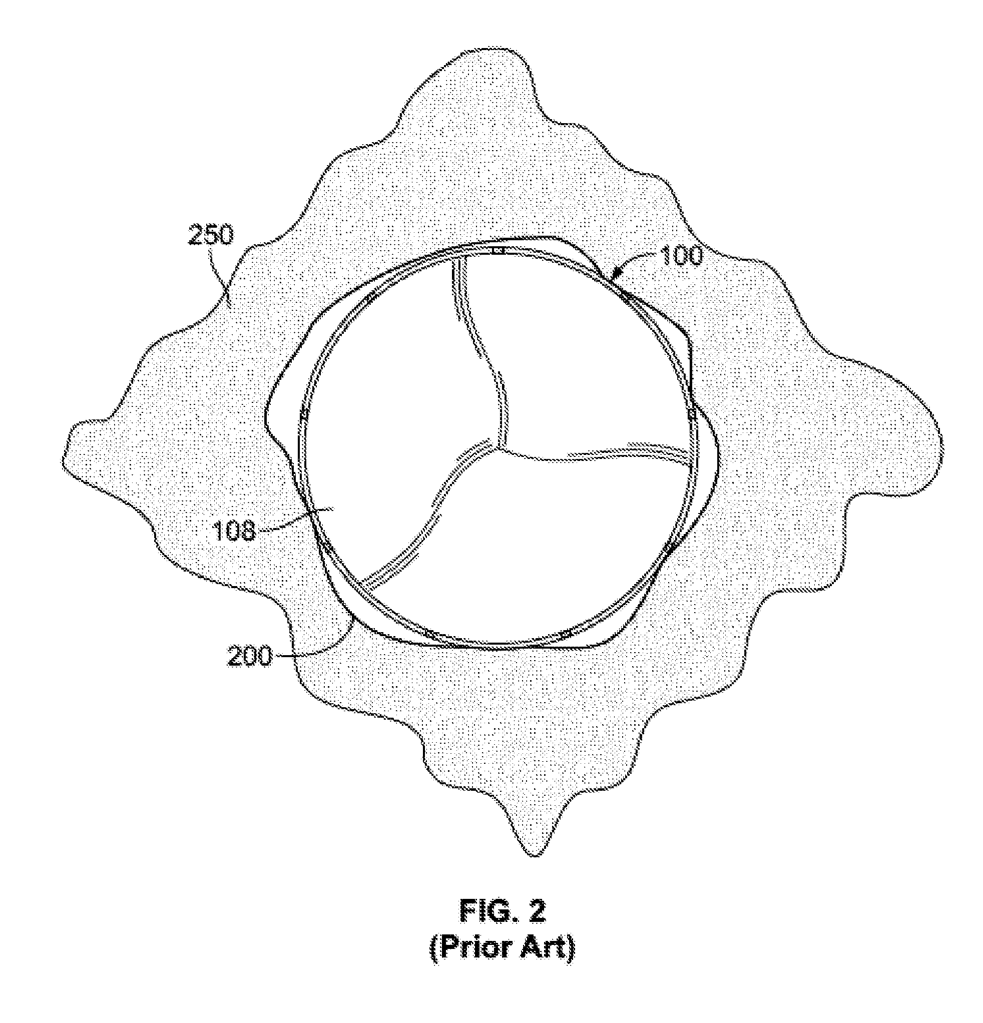 Prosthetic heart valve with expandable microspheres